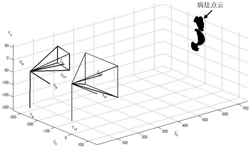 Optimization method of light projection direction in photodynamic therapy