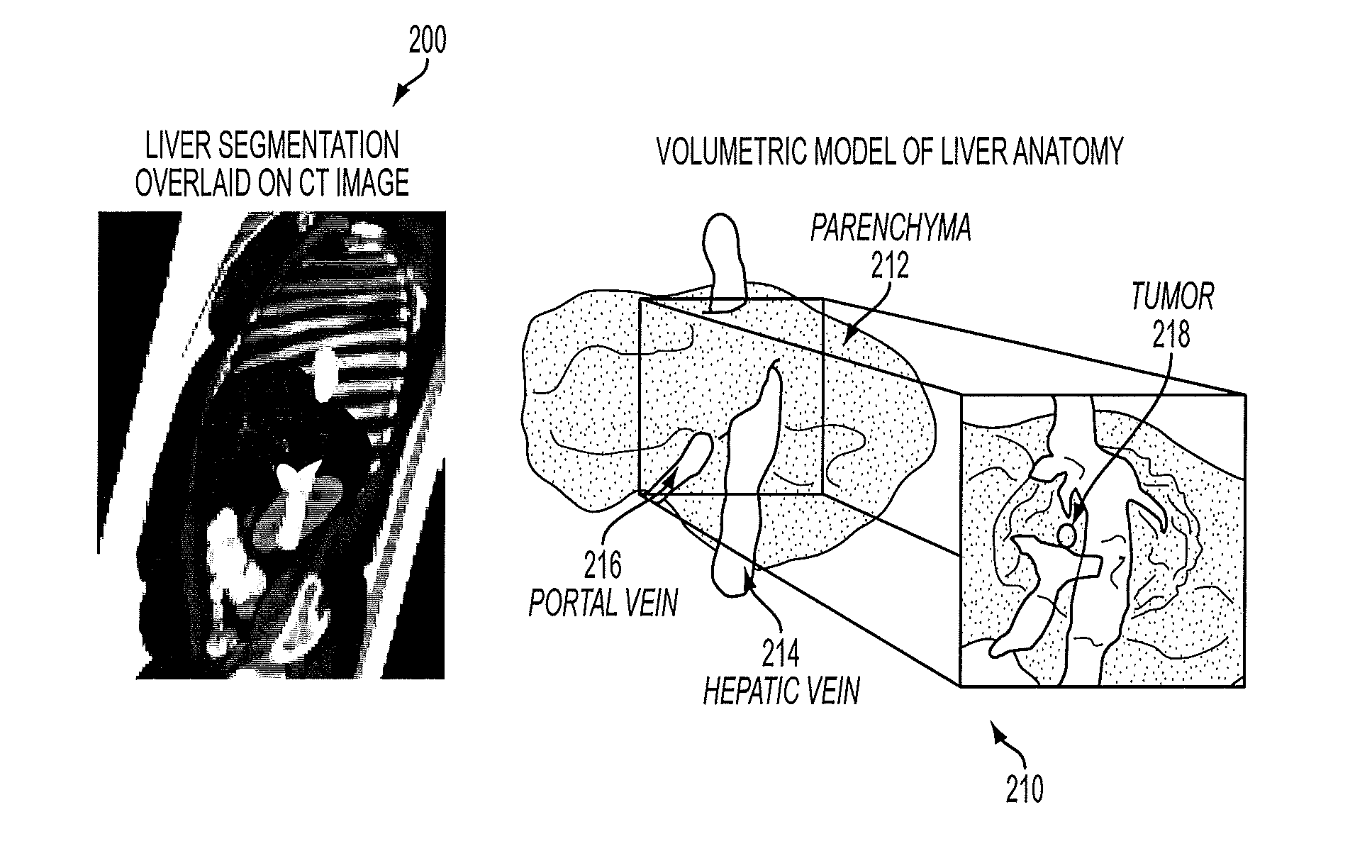 System And Method For Interactive Patient Specific Simulation Of Radiofrequency Ablation Therapy