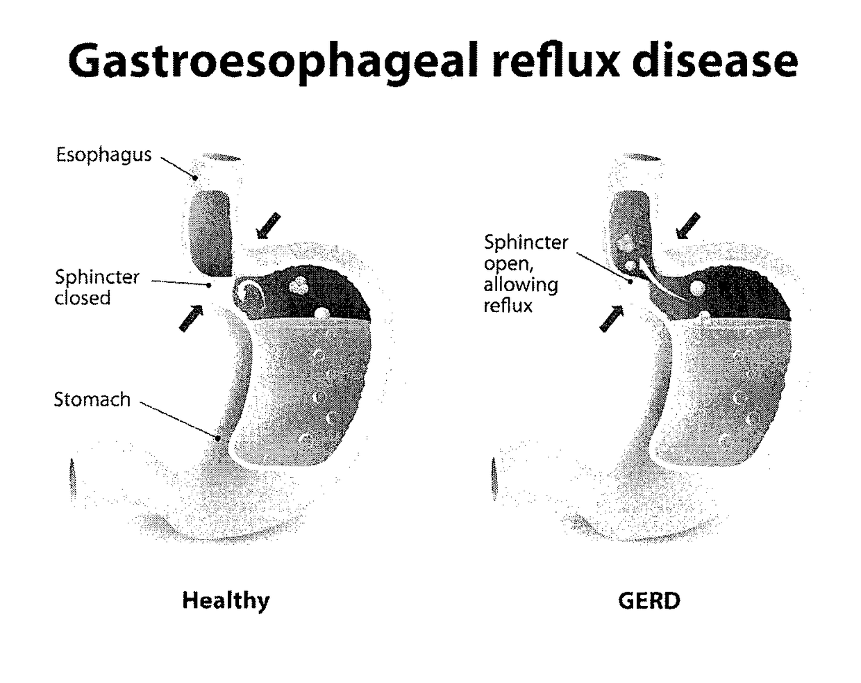 Method and system for reducing the likelihood of colorectal cancer in a human being