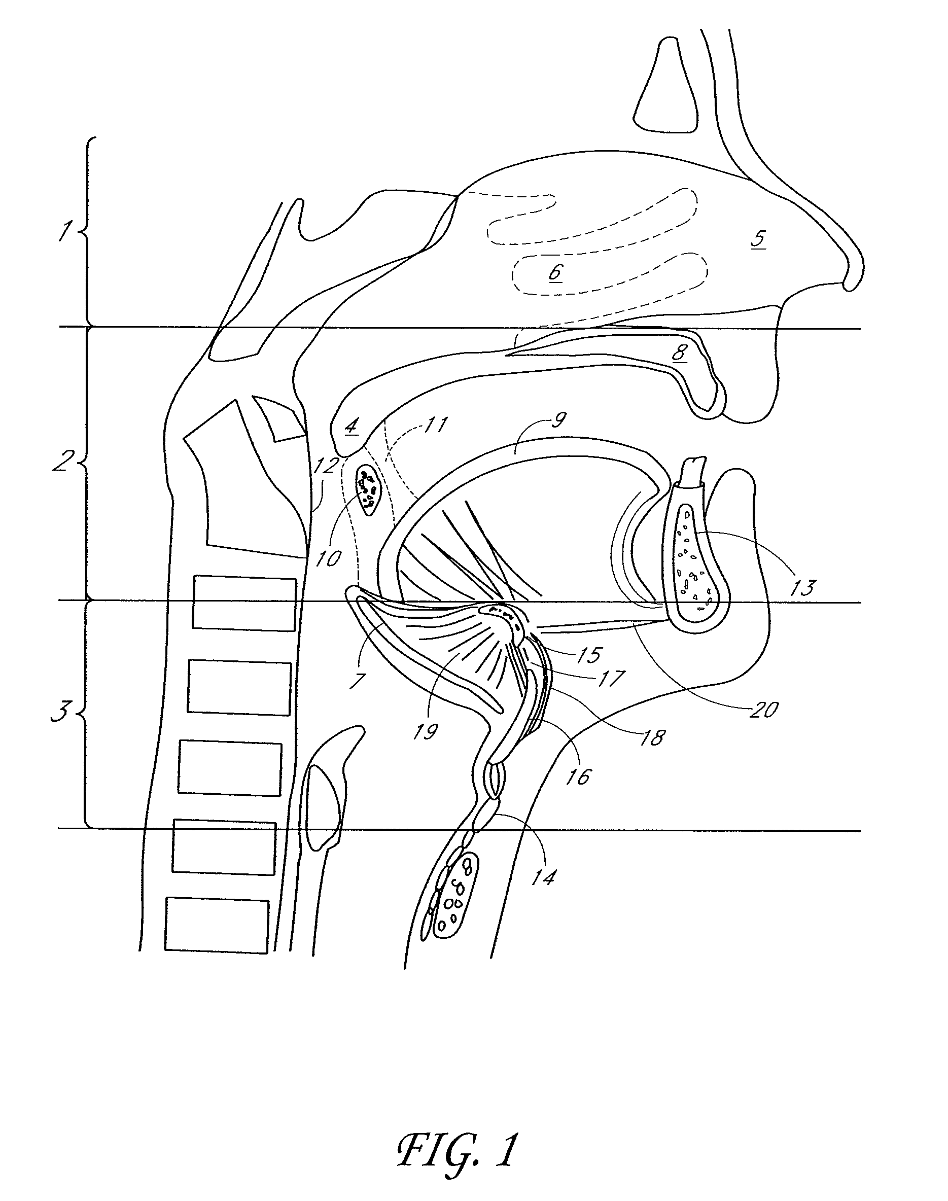 System and method for percutaneous palate remodeling