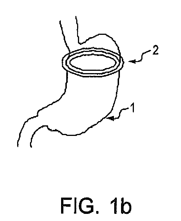 Artificial gastric valve