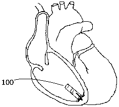 Self-synchronizing wireless heart pacemaker and stimulating method thereof