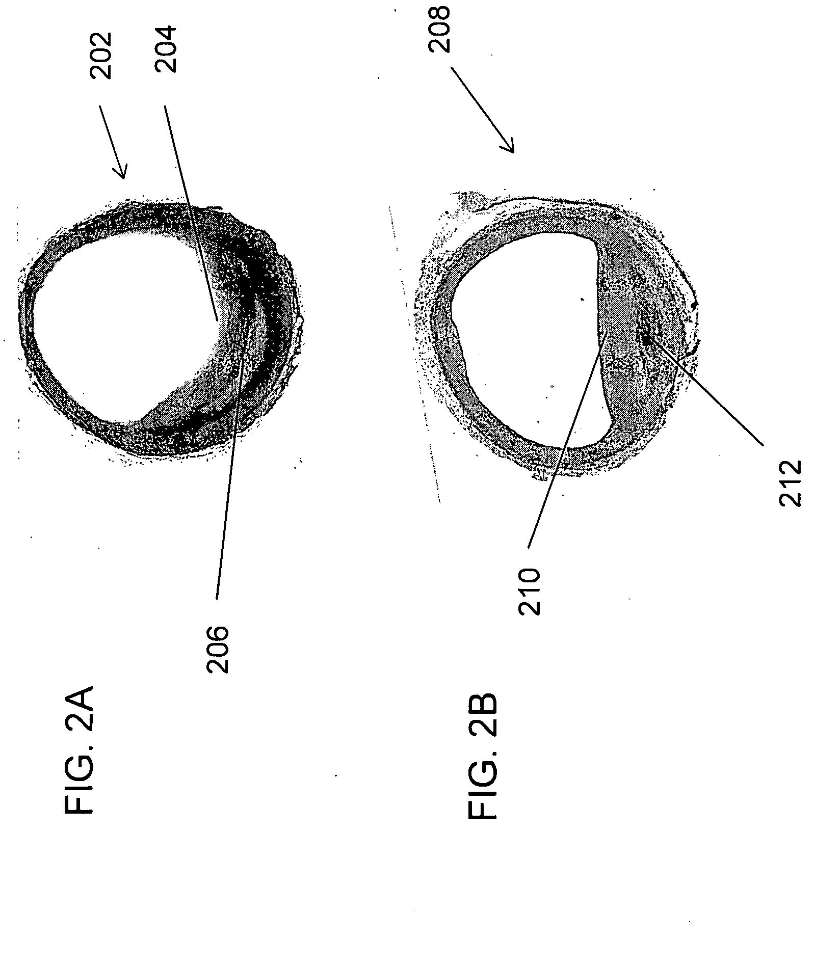 Large Animal Model for Human-Like Advanced Atherosclerotic Plaque