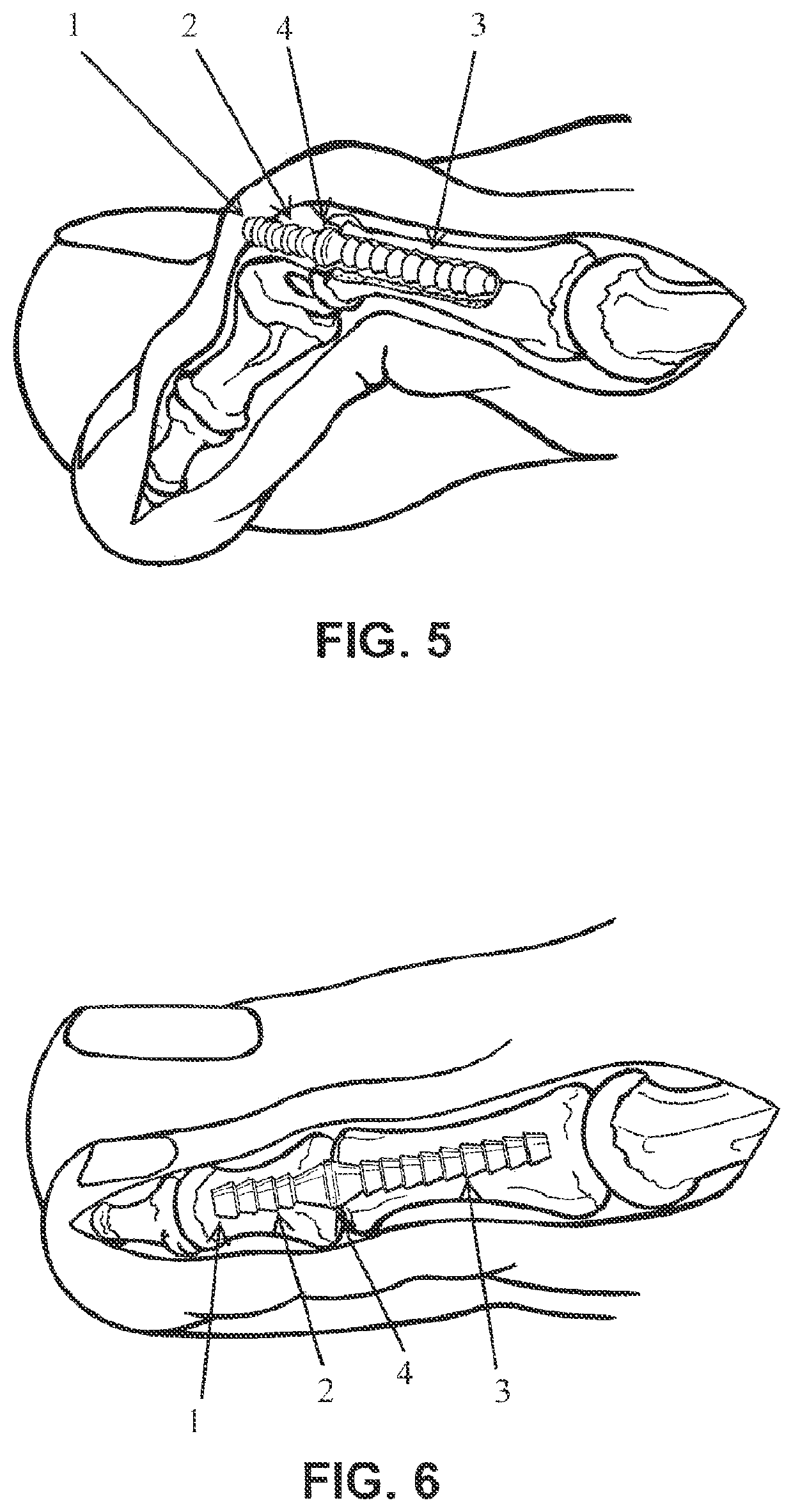 Cortical bone pin