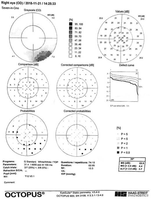 Medicine for treating glaucoma and preparation method thereof