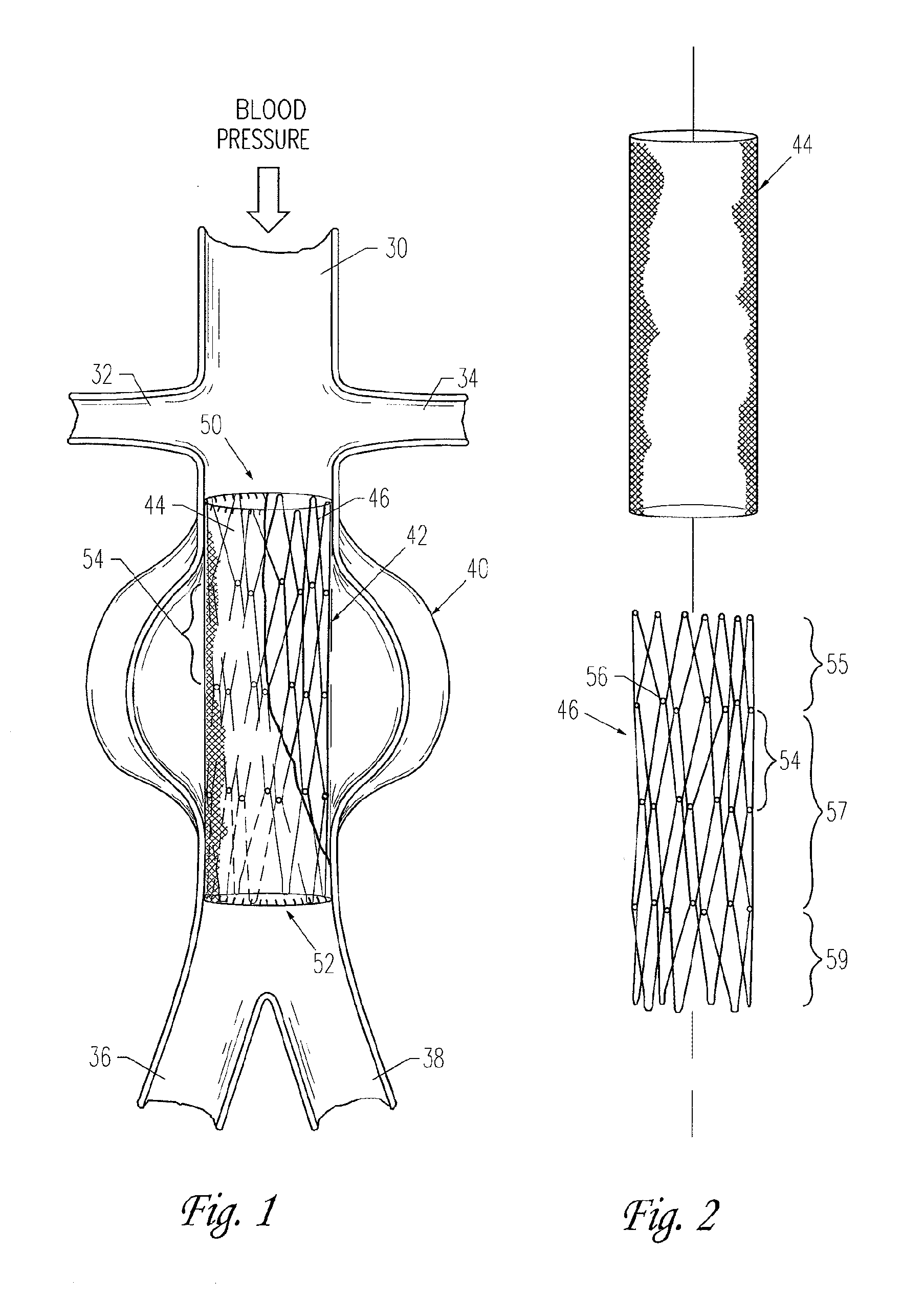 Implantable vascular graft