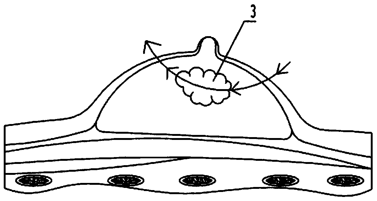 Breast abscess puncture and drainage device