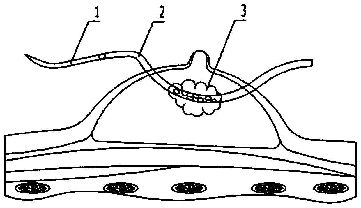 Breast abscess puncture and drainage device