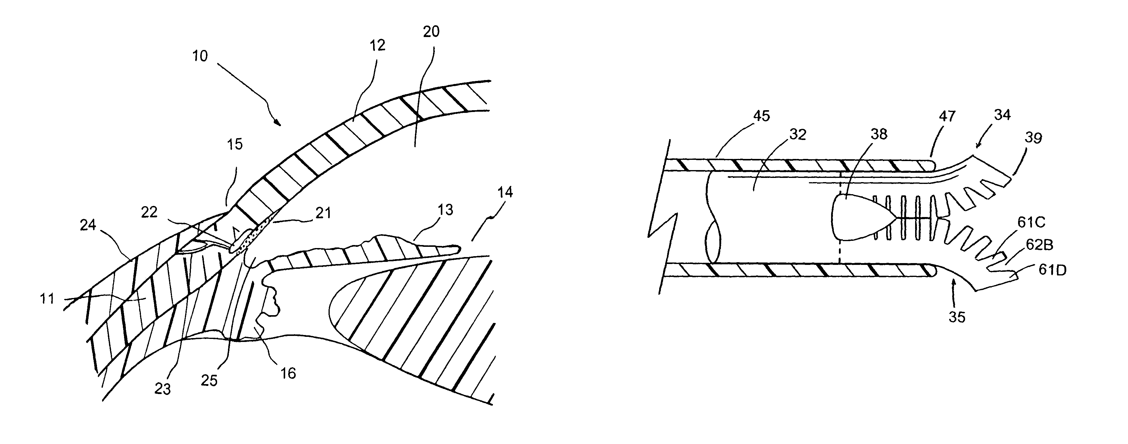 Implant with pressure sensor for glaucoma treatment