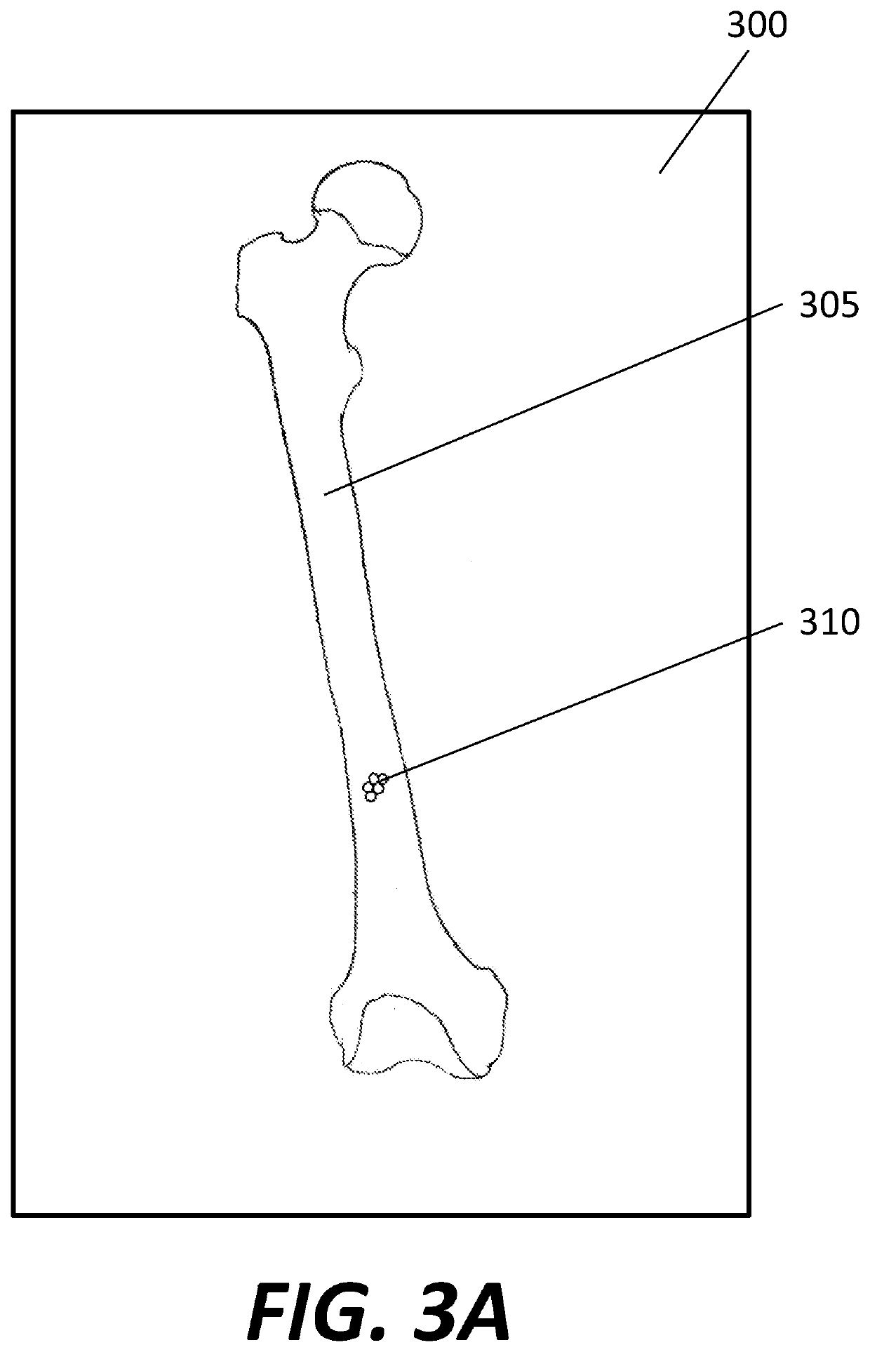 CT Based Probabilistic Cancerous Bone Region Detection