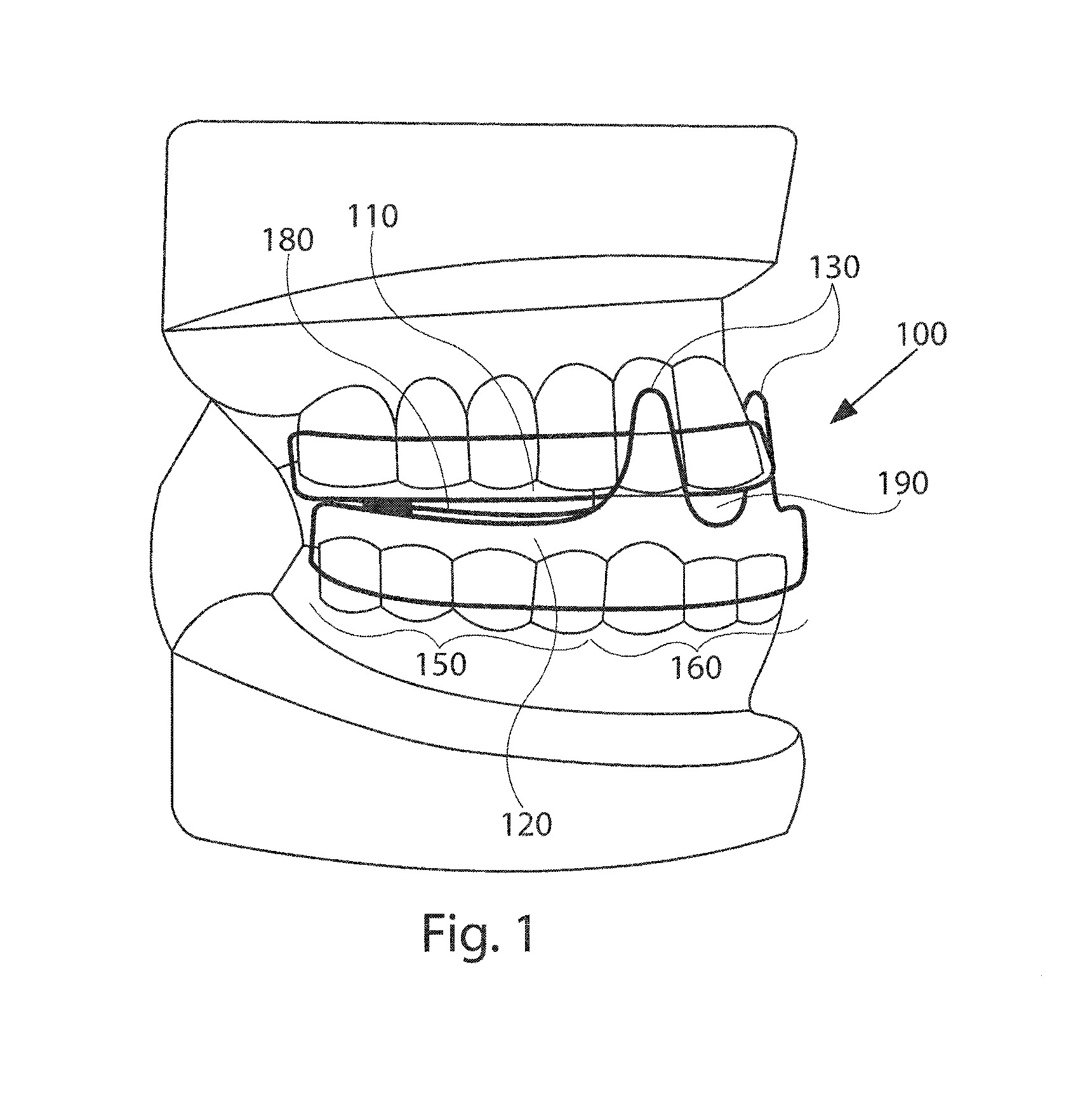 Mandibular advancement device