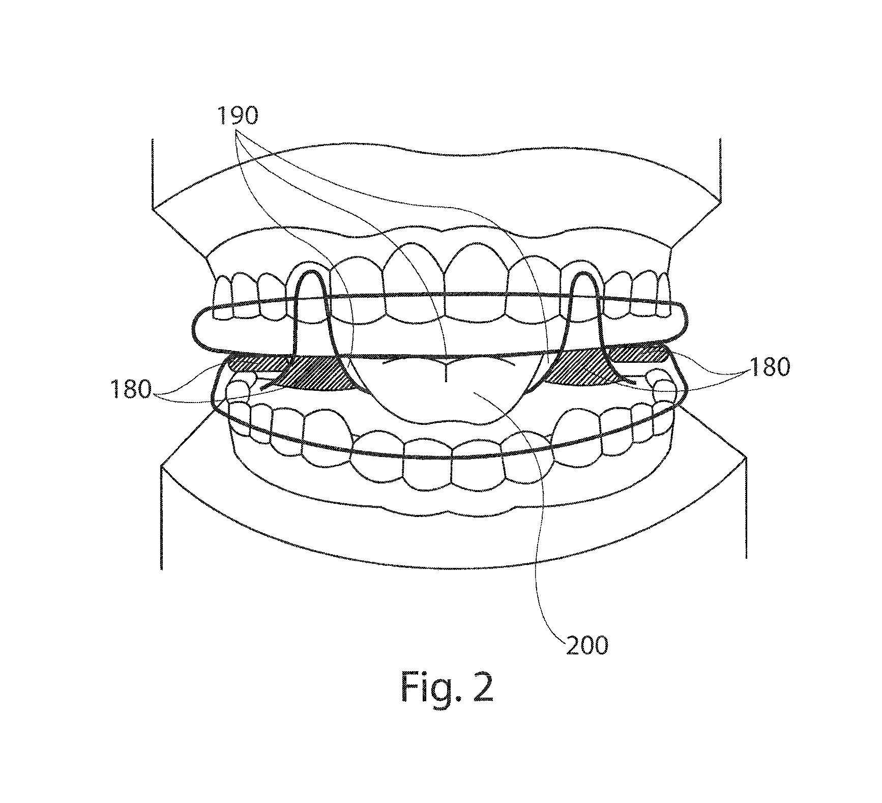 Mandibular advancement device