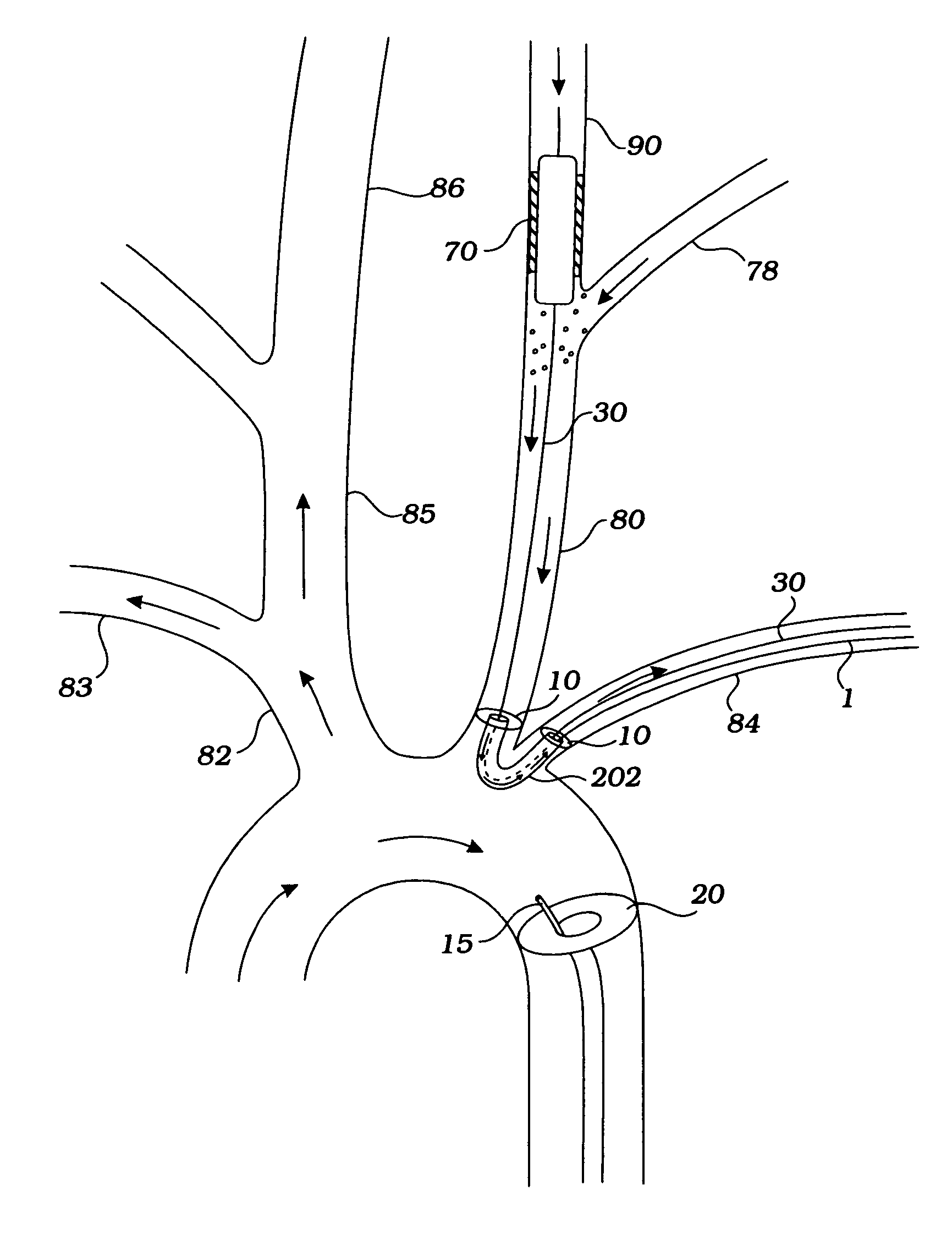 Devices and methods for preventing distal embolization using flow reversal and perfusion augmentation within the cerebral vasculature