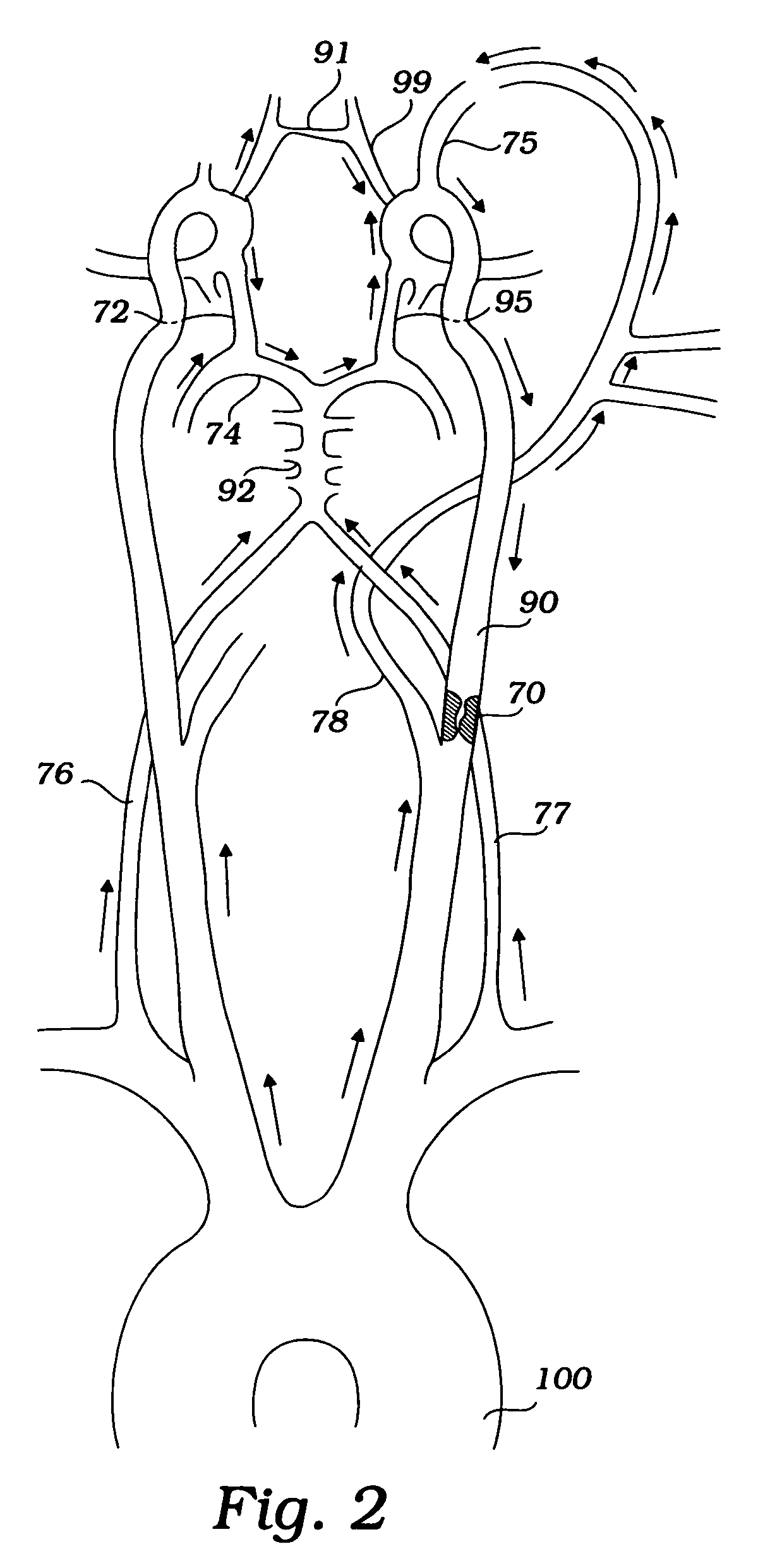 Devices and methods for preventing distal embolization using flow reversal and perfusion augmentation within the cerebral vasculature