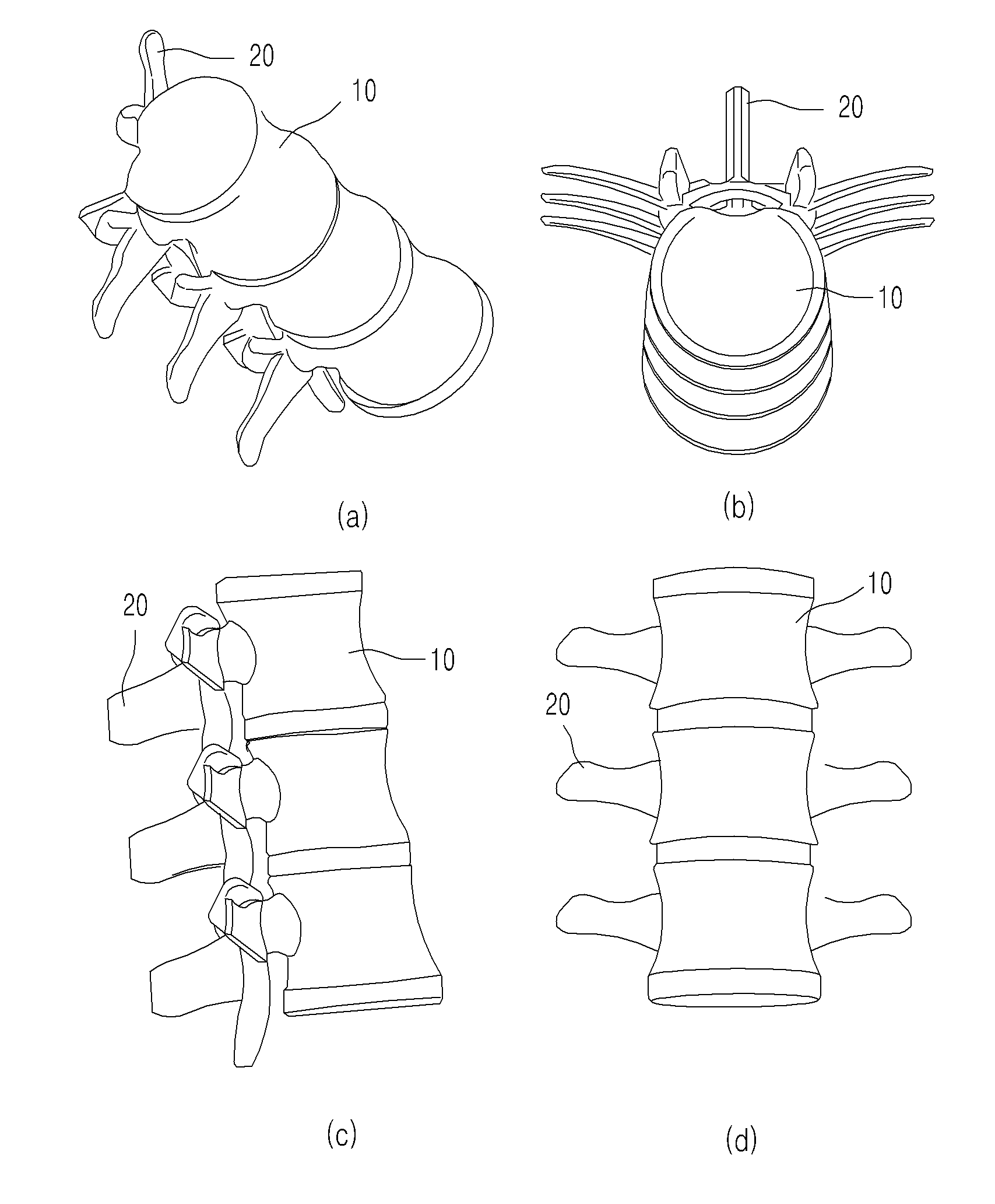 Image-based patient-specific medical spinal surgery method and spinal prosthesis