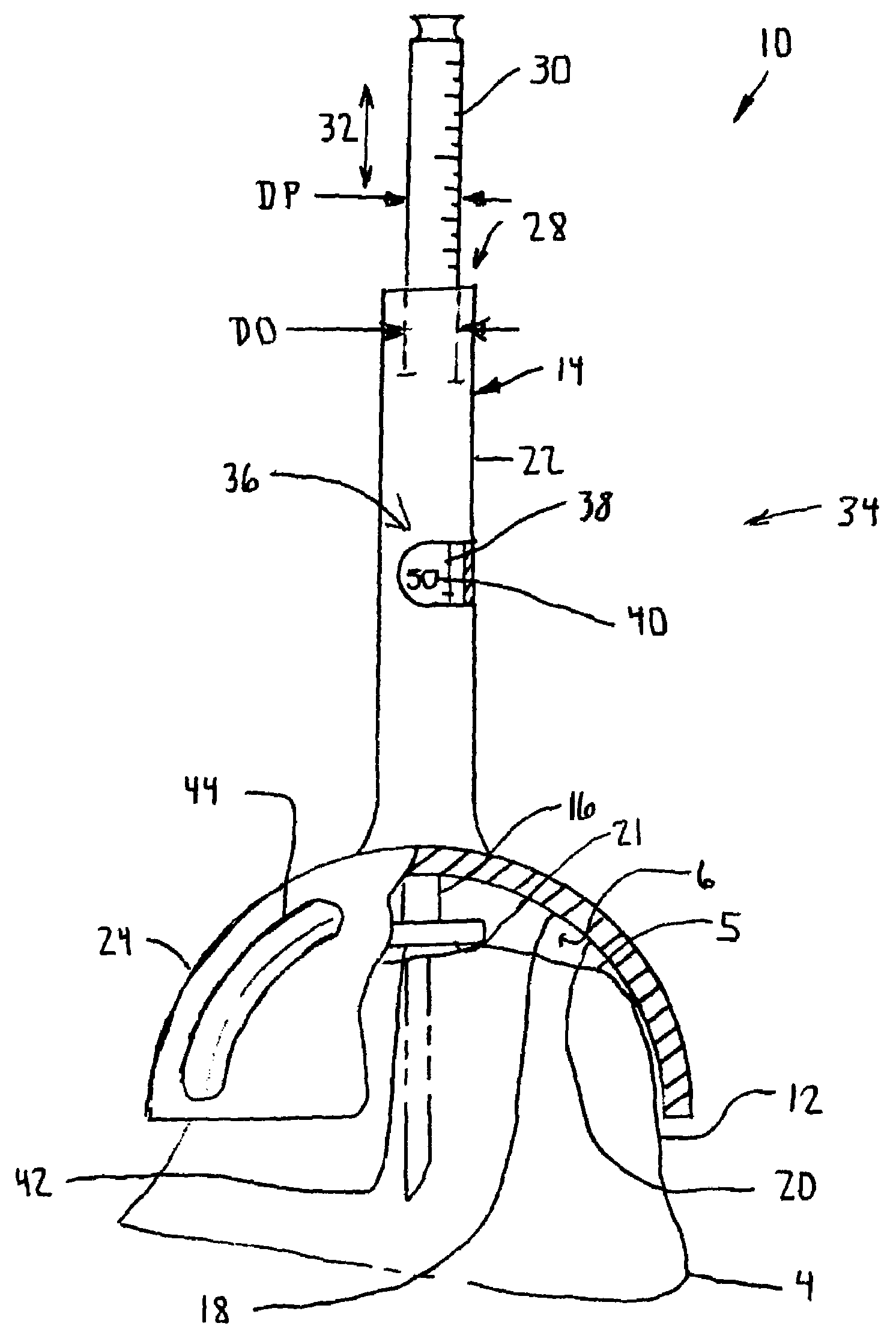 Arthroplasty sizing gauge