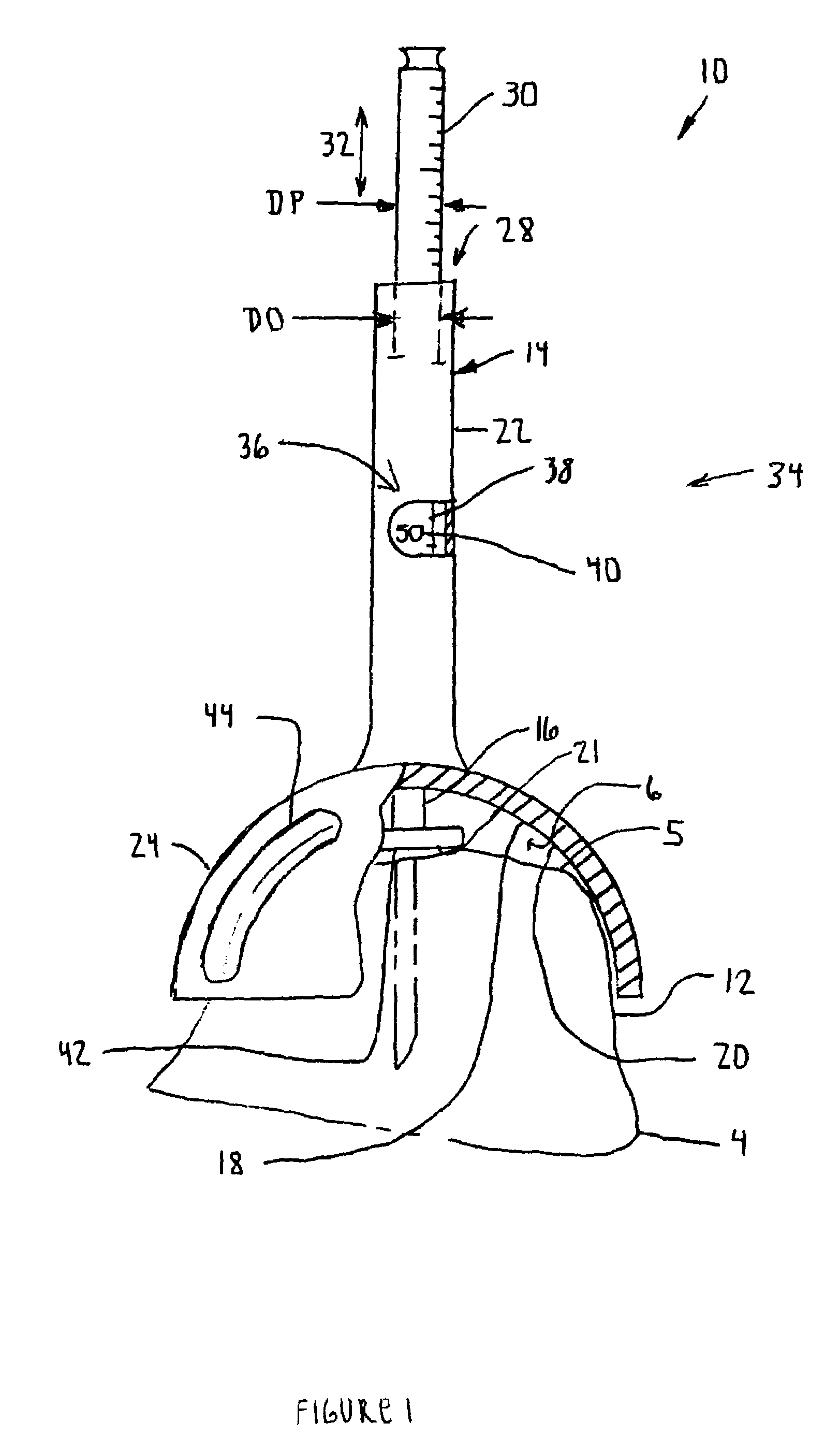 Arthroplasty sizing gauge