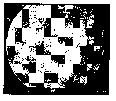 Automatic eye fundus image vessel detecting method based on PCNN (pulse coupled neural network)