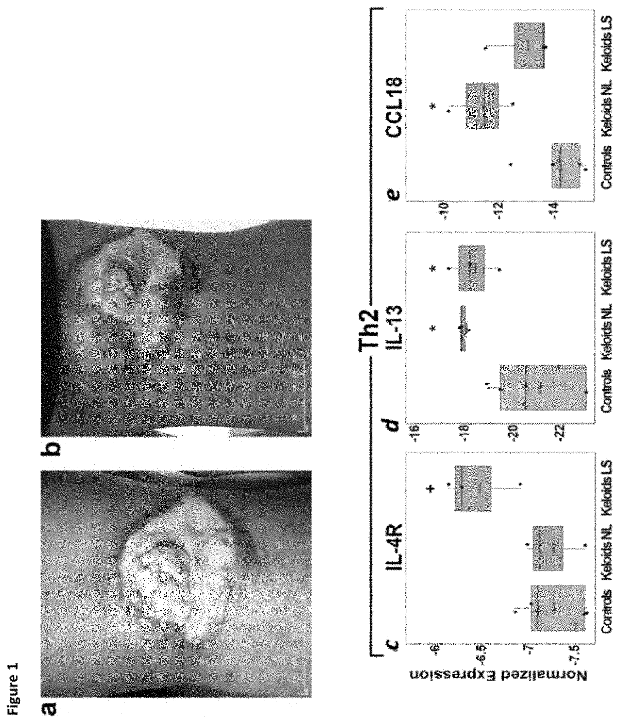 Method of treating keloids