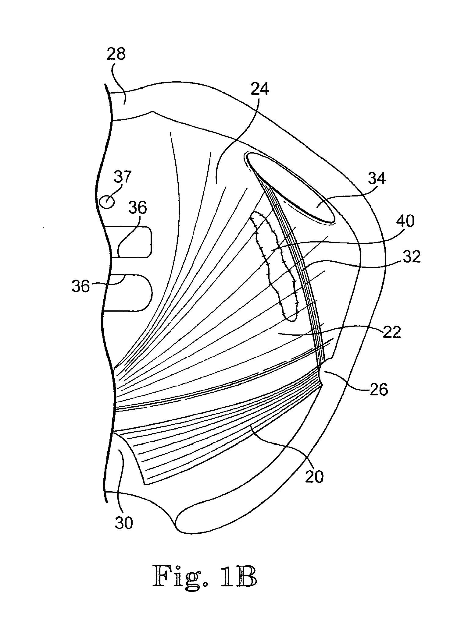 Minimally invasive levator avulsion repair