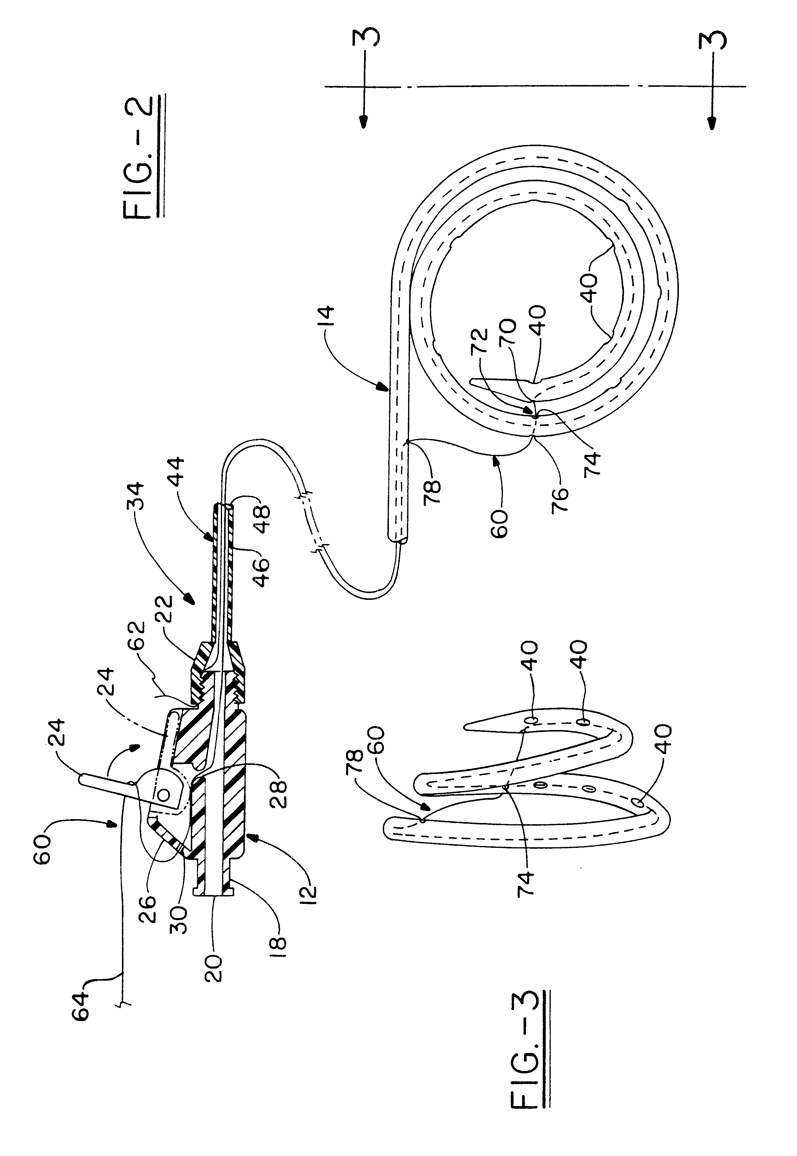 Double-loop catheter