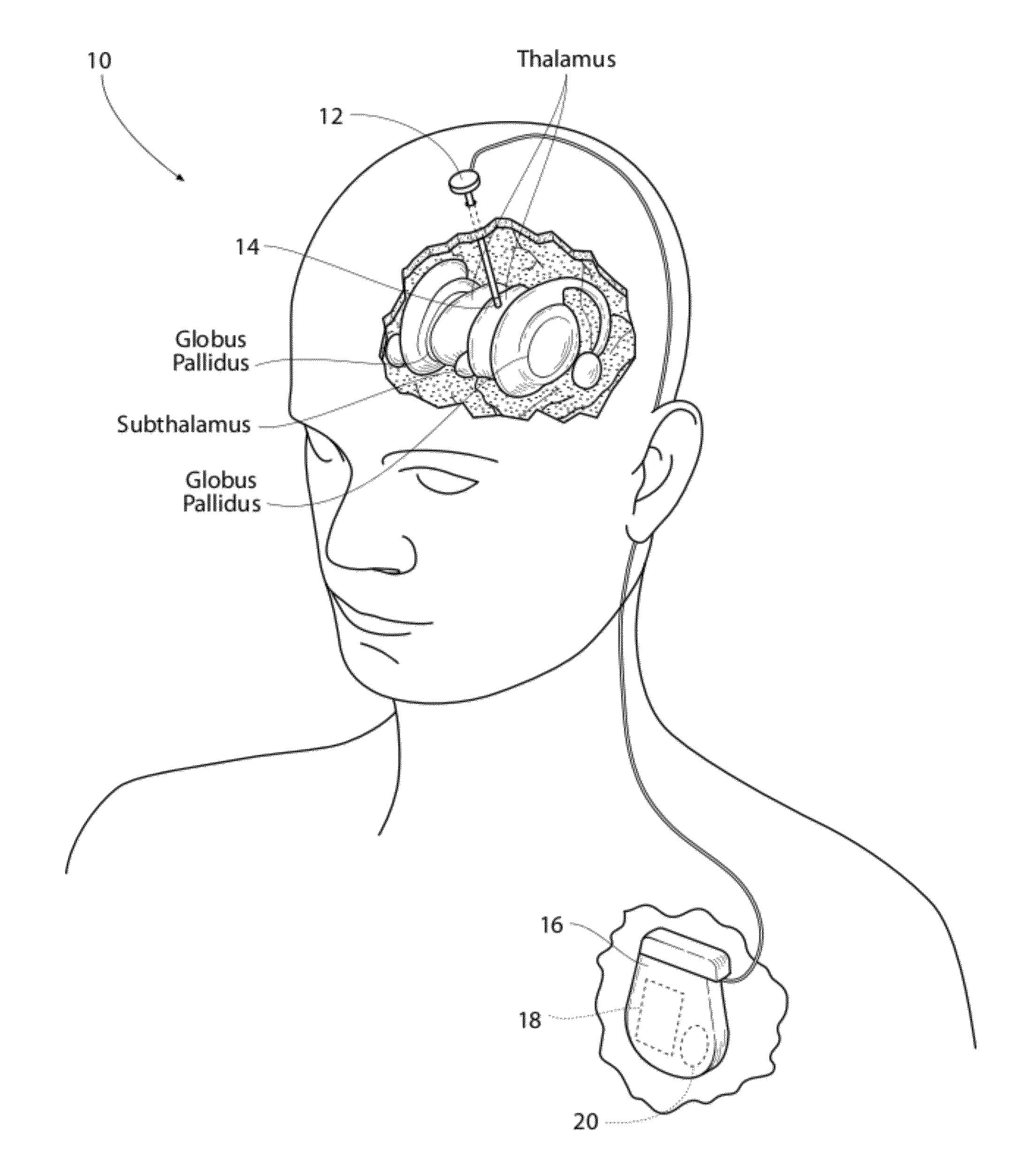 Waveform shapes for treating neurological disorders optimized for energy efficiency