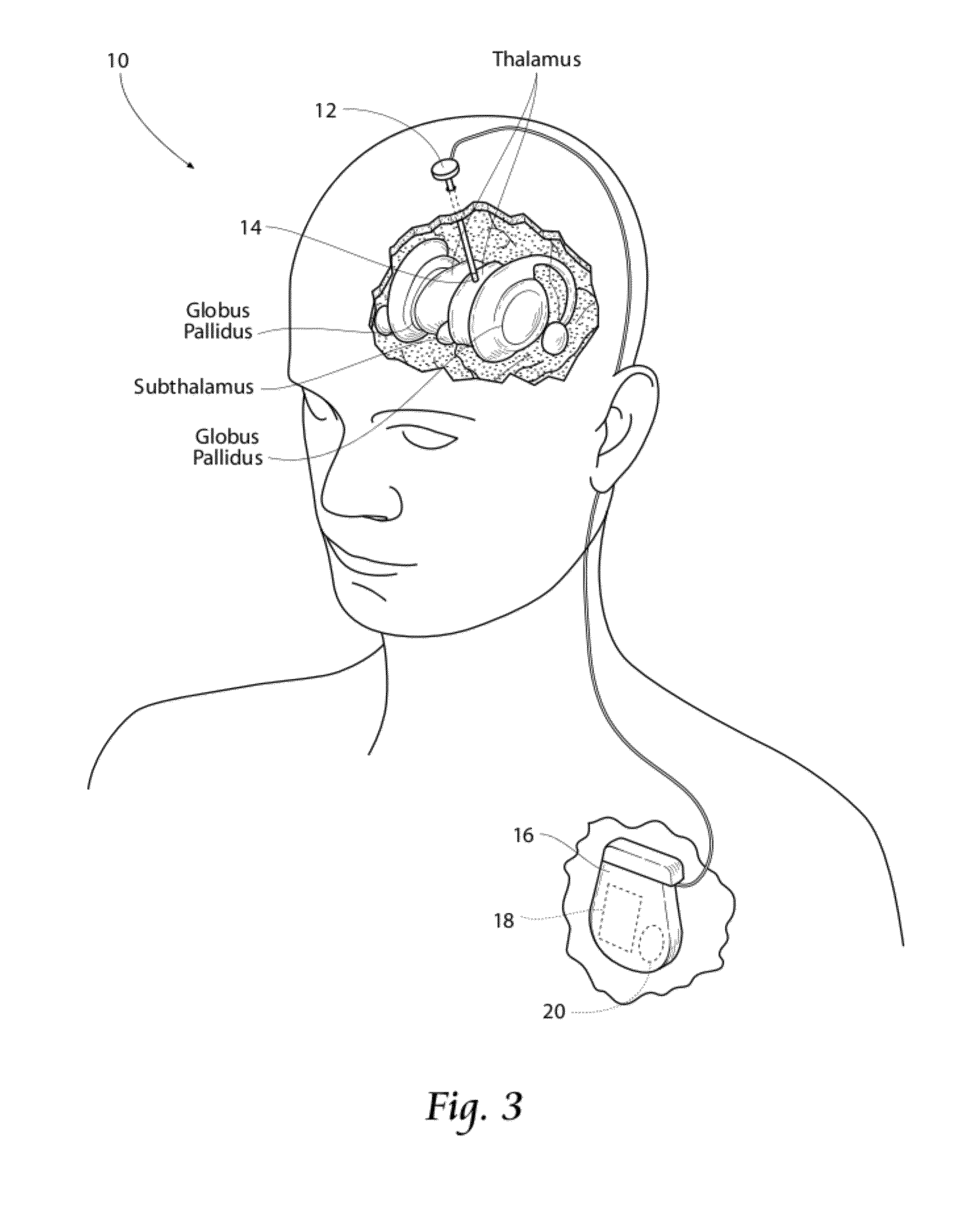 Waveform shapes for treating neurological disorders optimized for energy efficiency