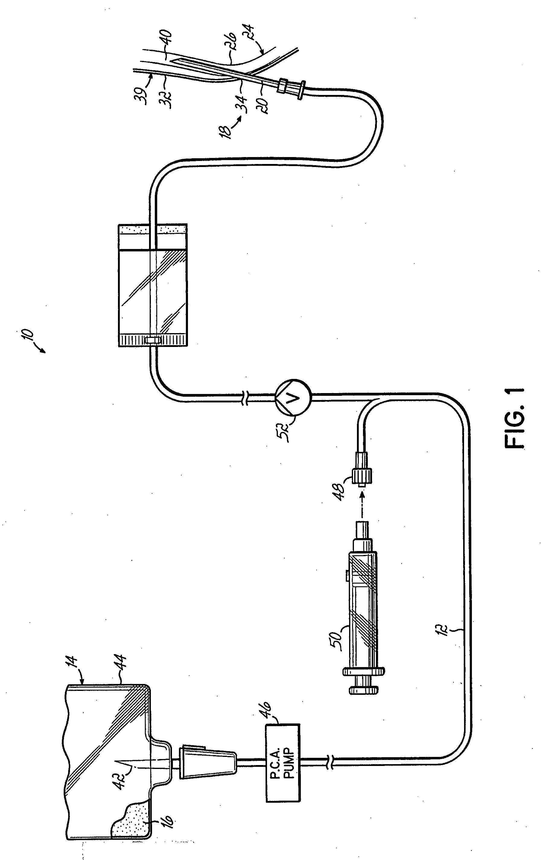 Central Nervous System Administration of Medications by Means of Pelvic Venous Catheterization and Reversal of Batson's Plexus