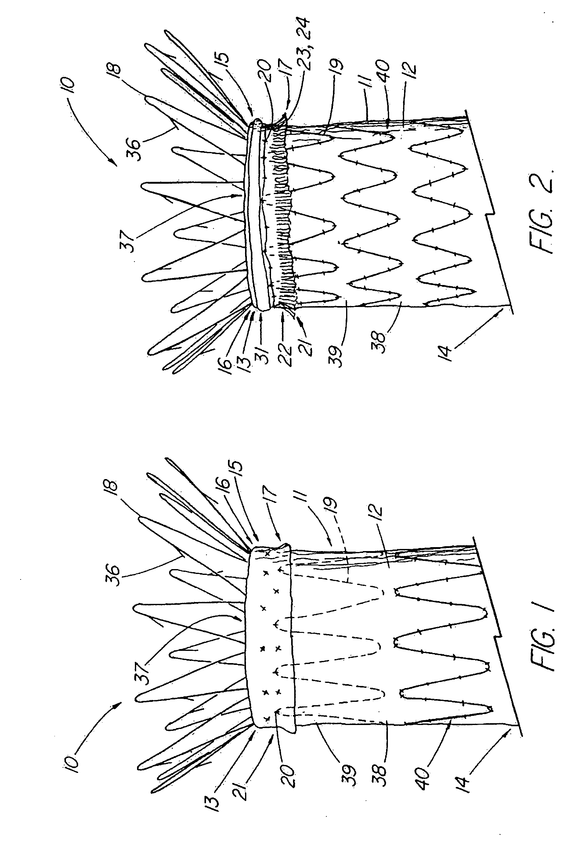 Endoluminal device with extracellular matrix material and methods