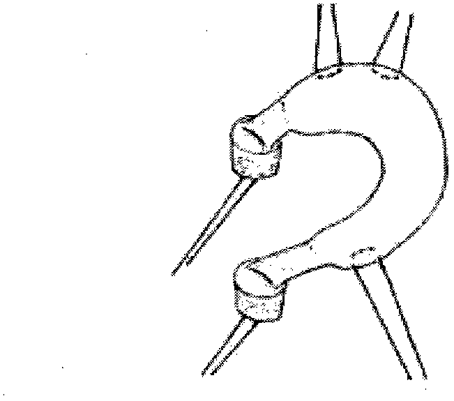 Meniscus transplanting bone bolt fixing technology and device