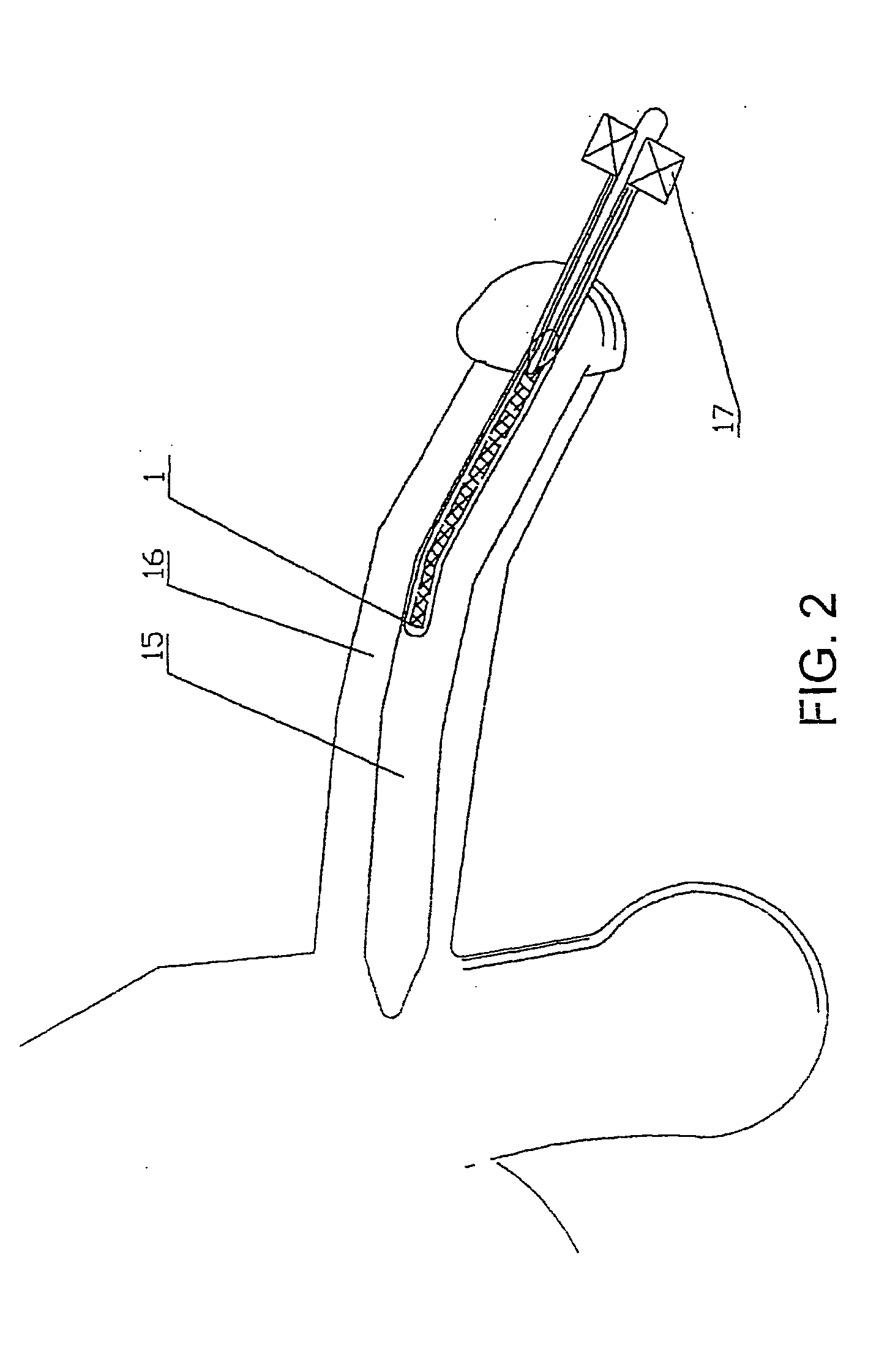 Penile prosthesis and method of implantation