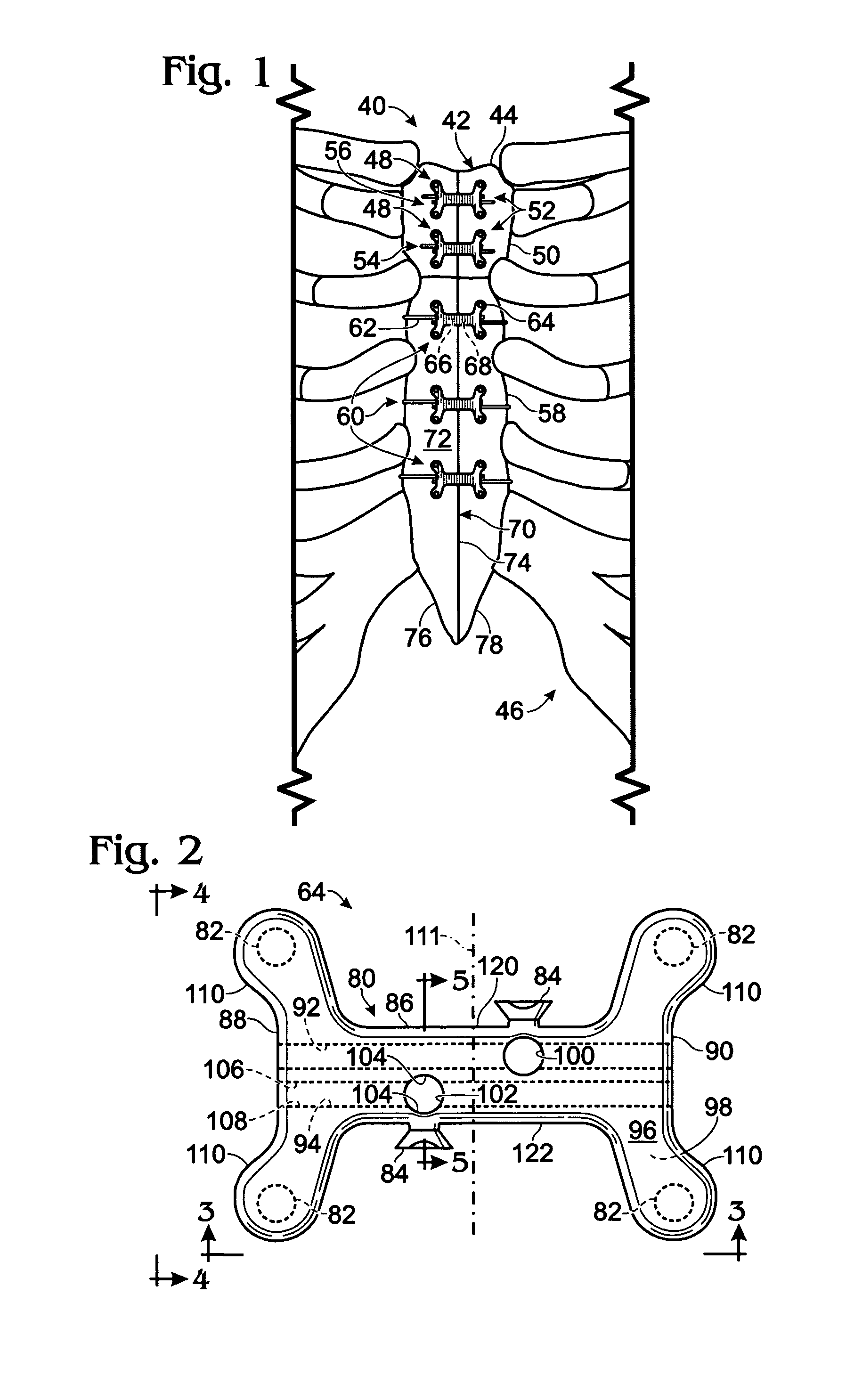 Cerclage system for bone