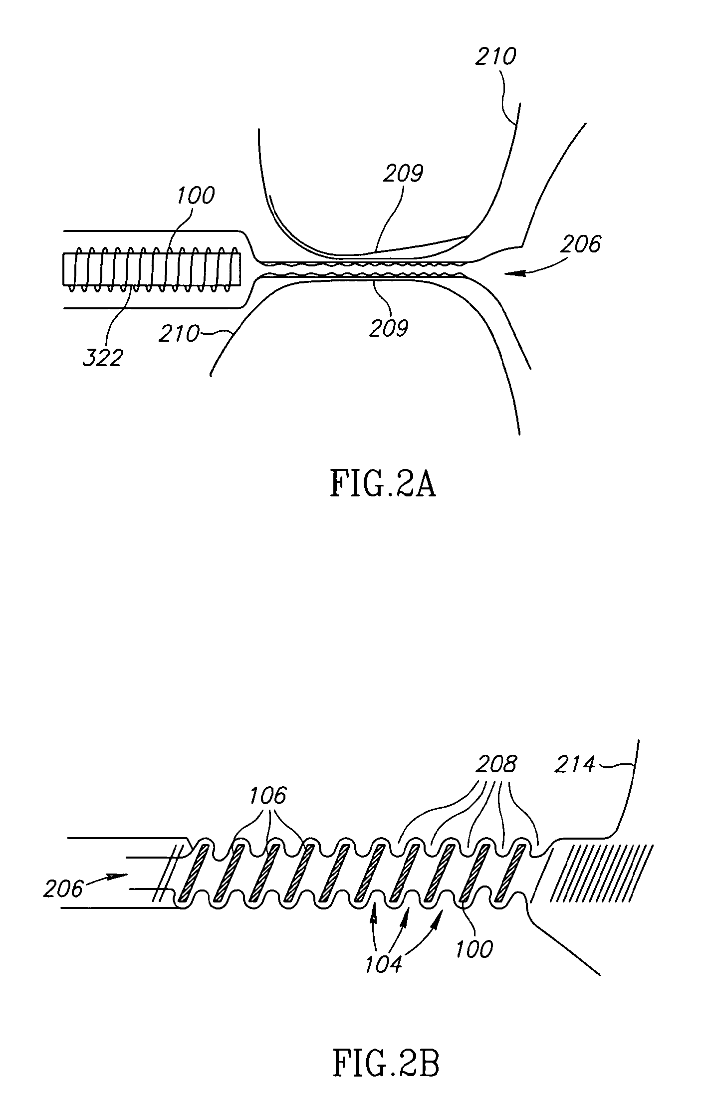 Prostate Treatment Stent