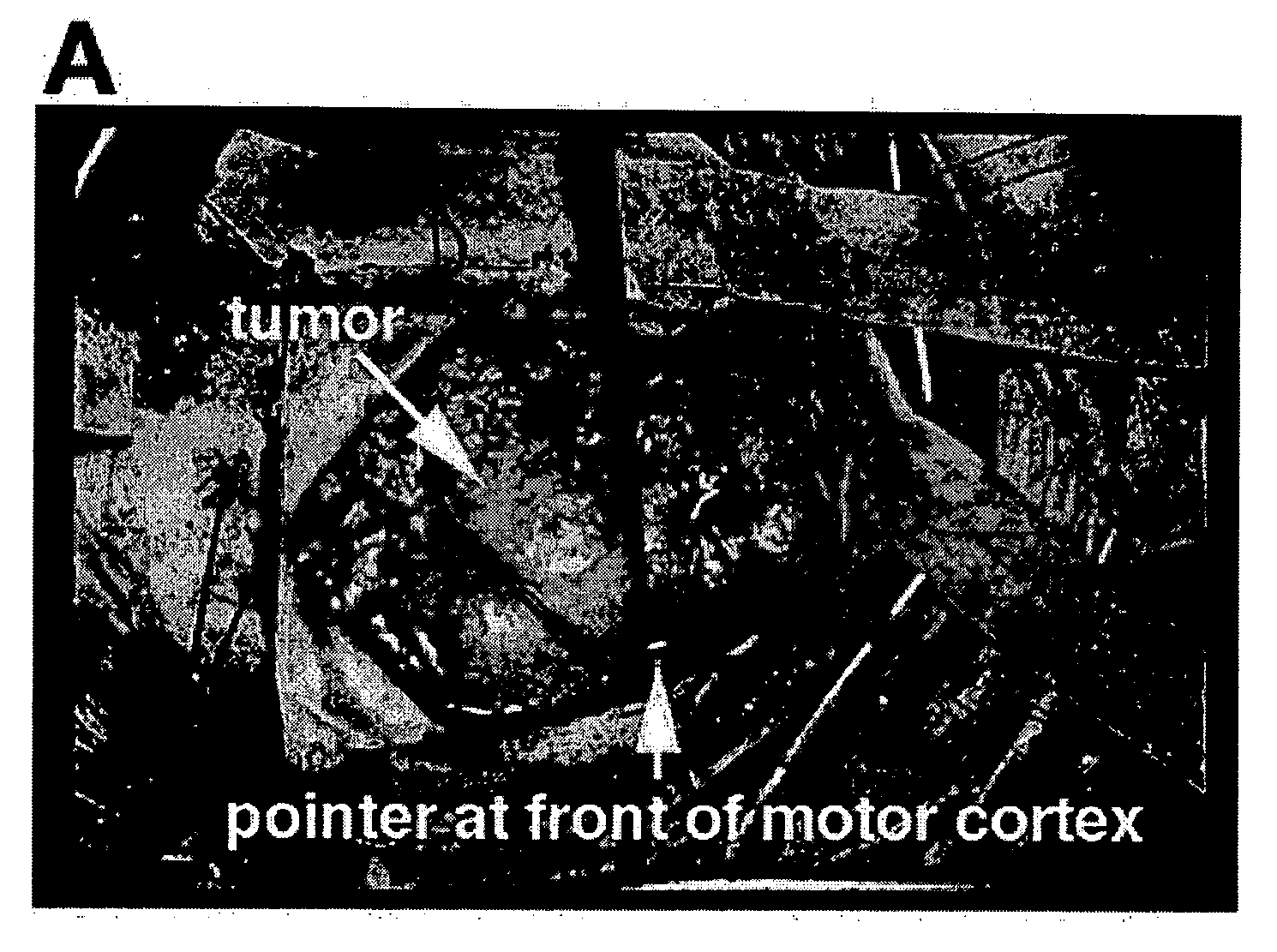 Fluorescent chlorotoxin conjugate and method for intra-operative visualization of cancer