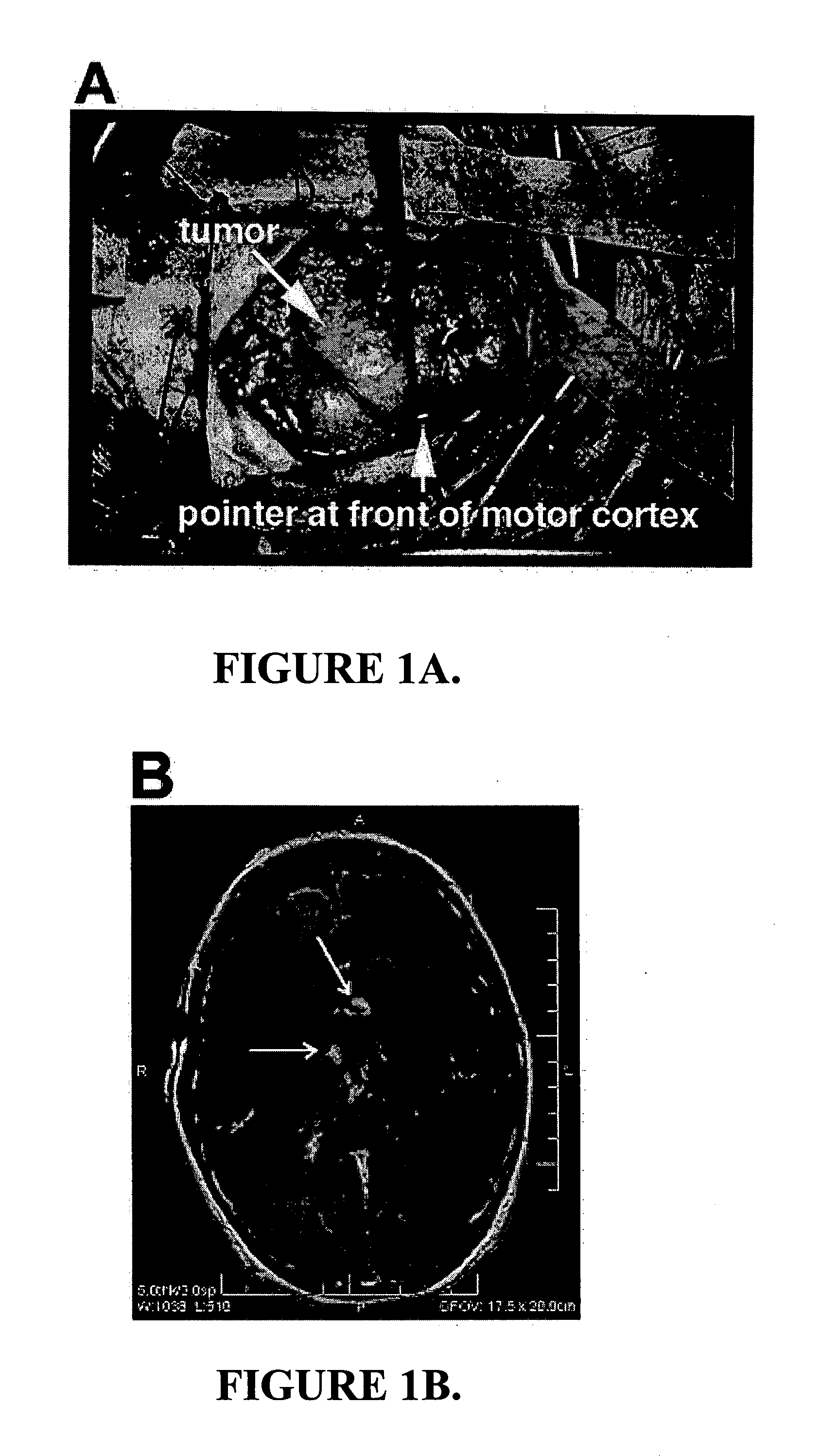 Fluorescent chlorotoxin conjugate and method for intra-operative visualization of cancer