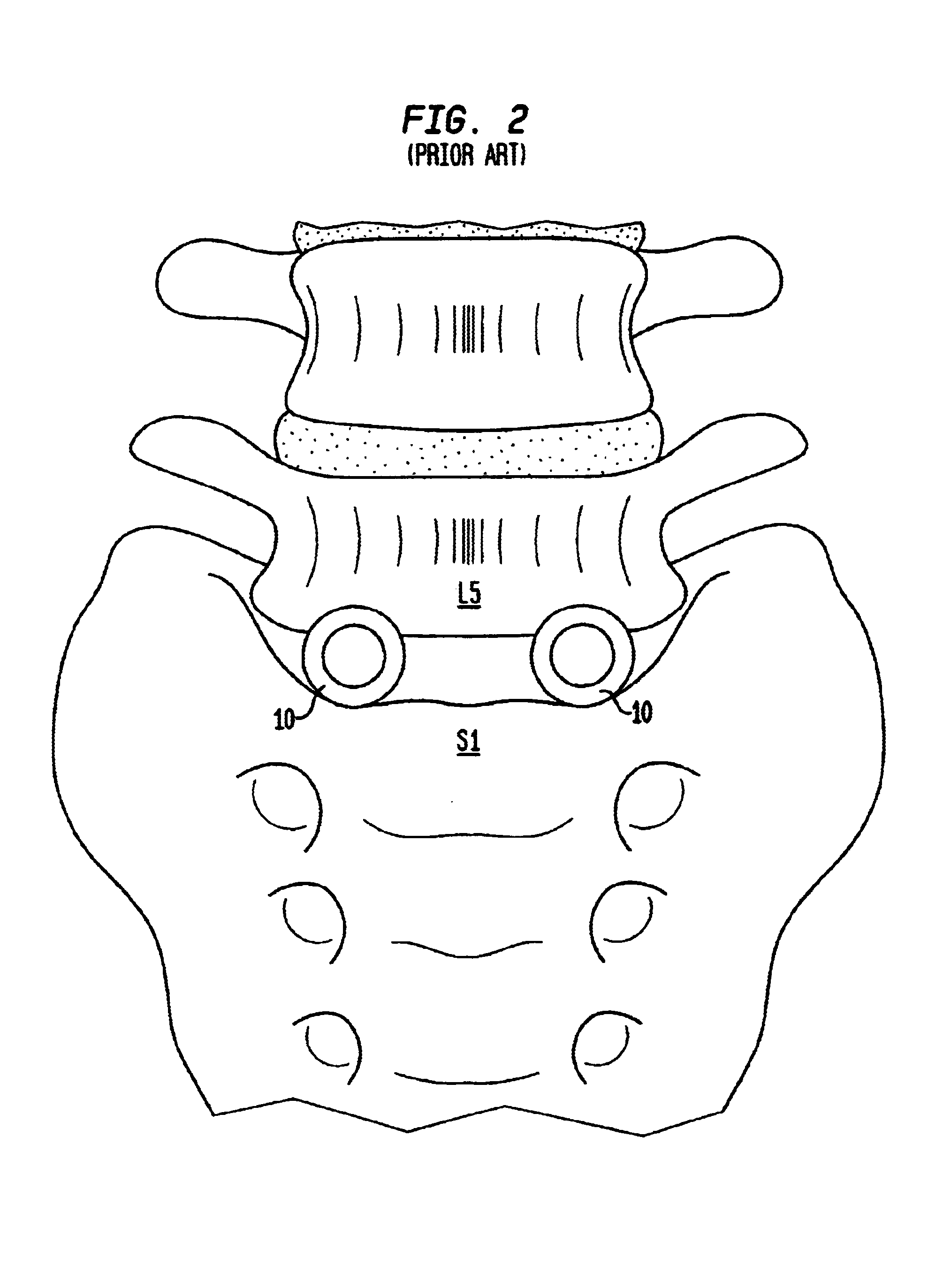 Artificial intervertebral disc having a slotted belleville washer force restoring element