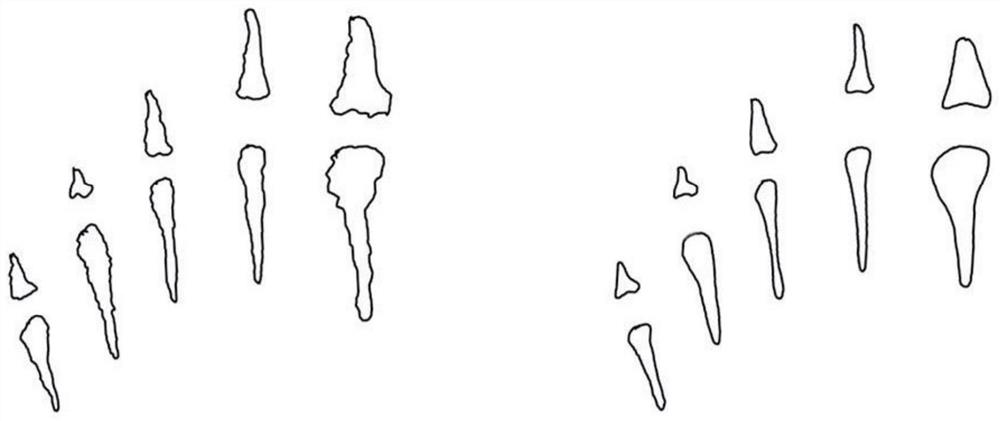 Preparation method of artificial metatarsophalangeal joint prosthesis