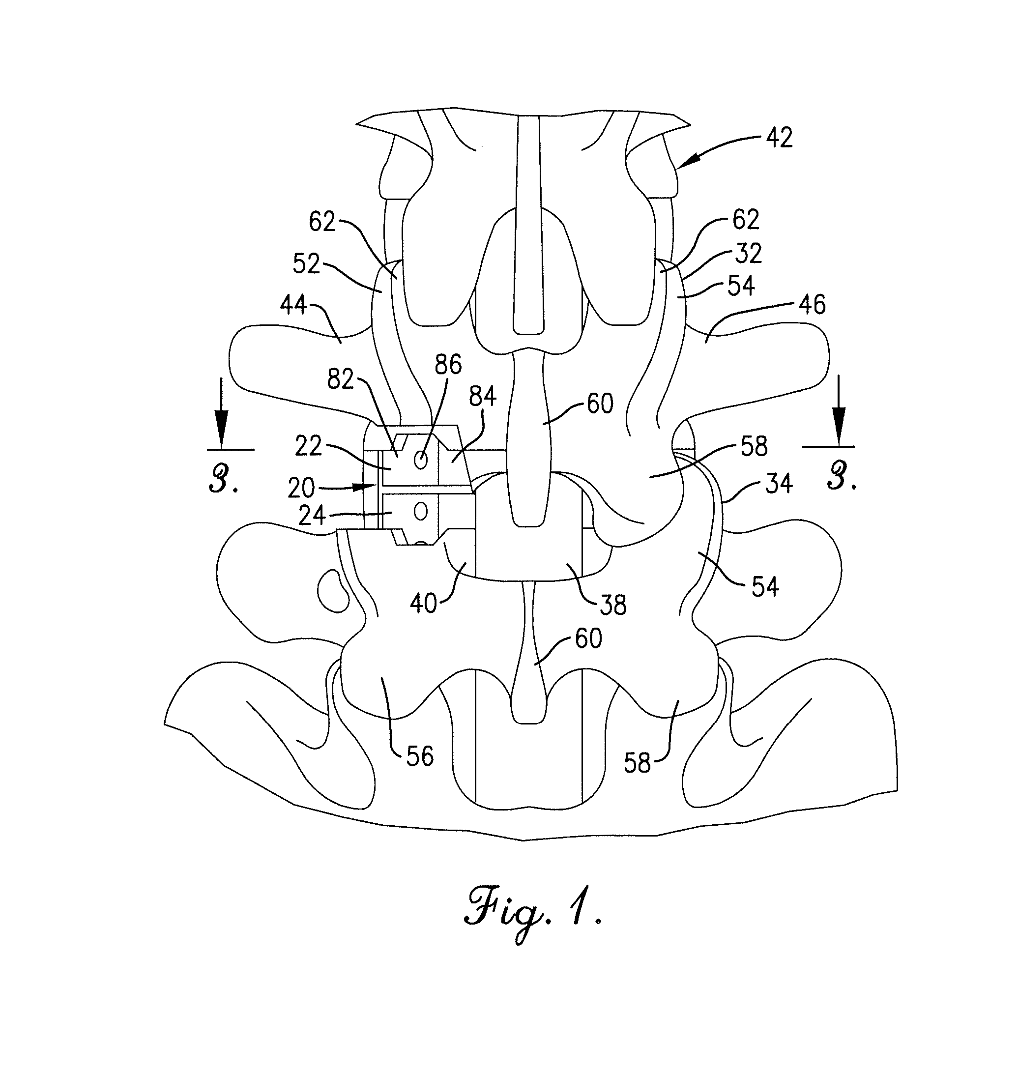 Artificial spinal disc, insertion tool, and method of insertion