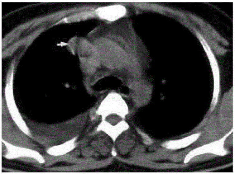 Human tissue focus detection method based on infrared thermal imaging technology