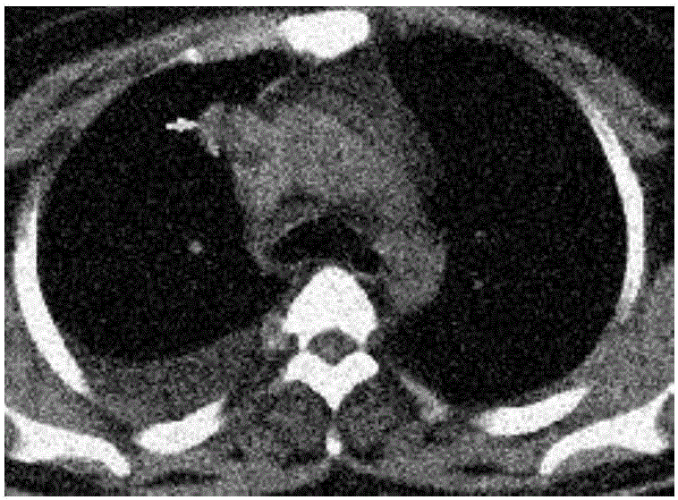 Human tissue focus detection method based on infrared thermal imaging technology