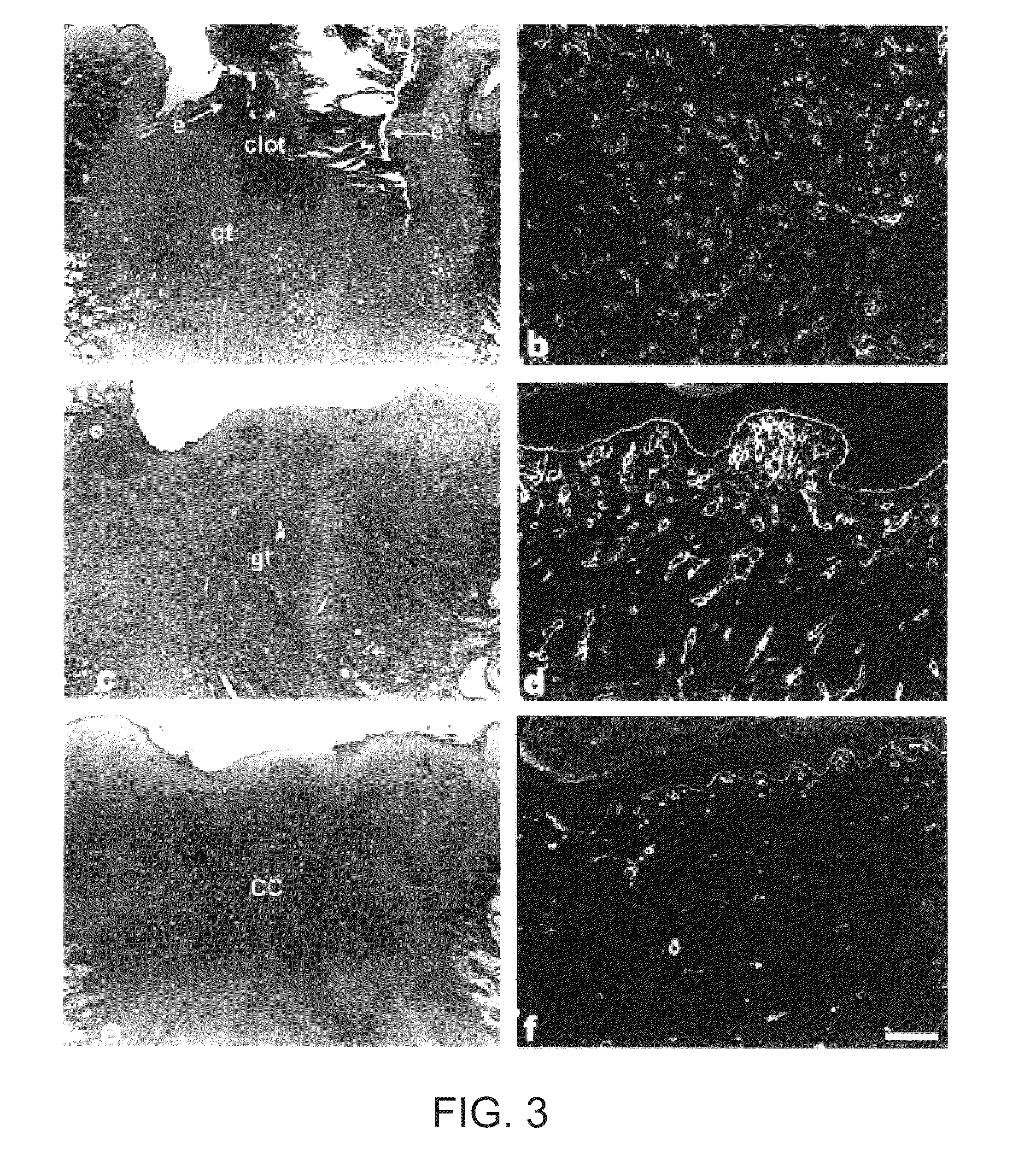 Combined administration of integrin receptor antagonists for Anti-angiogenic therapy