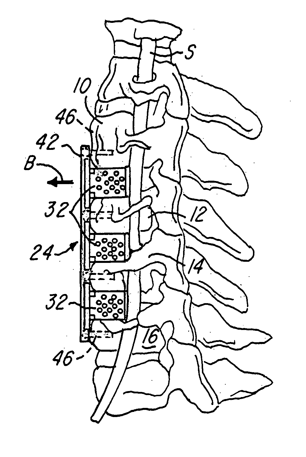 Spinal fusion system and method for fusing spinal bones