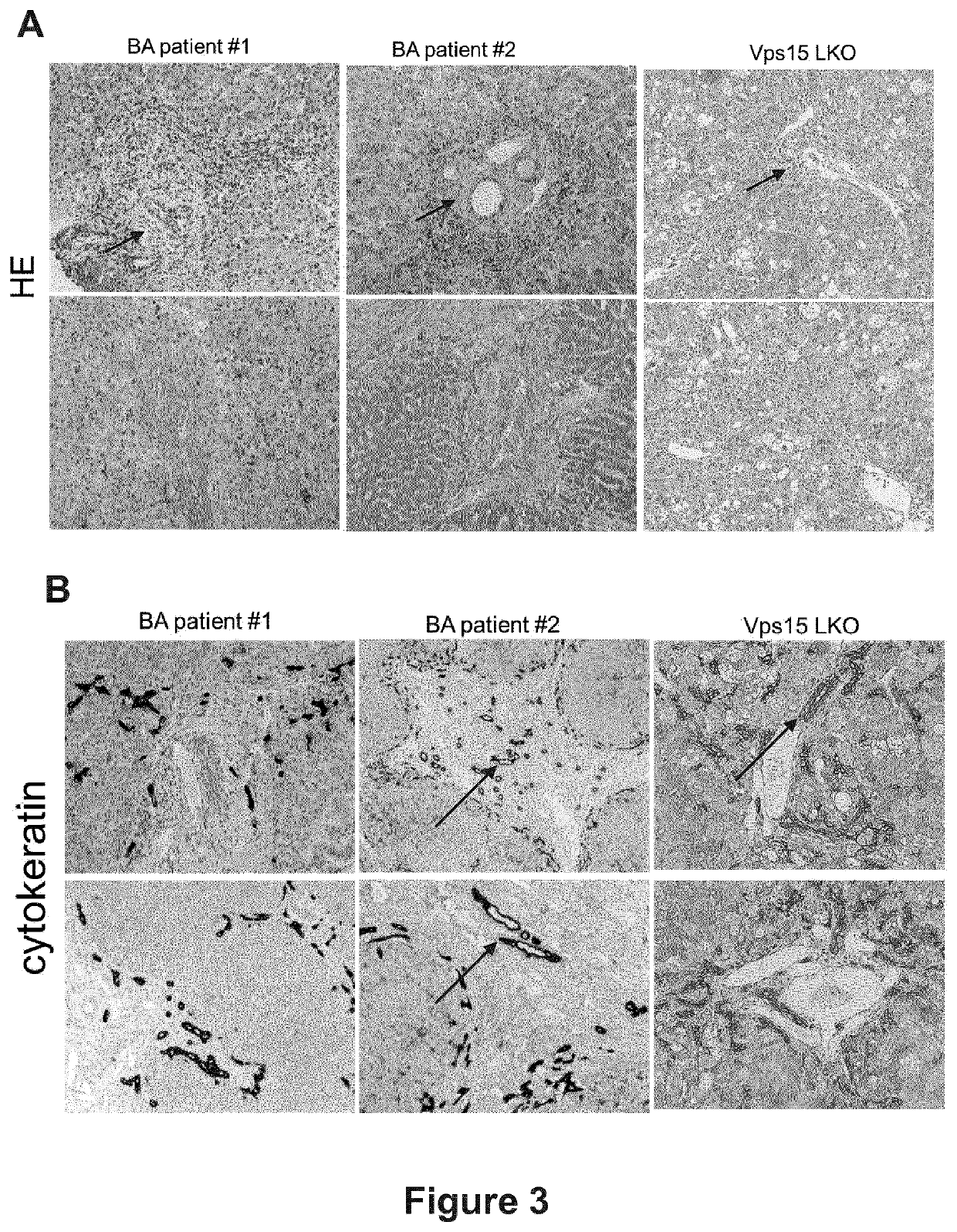 Treatment of diseases associated with biliary system destruction