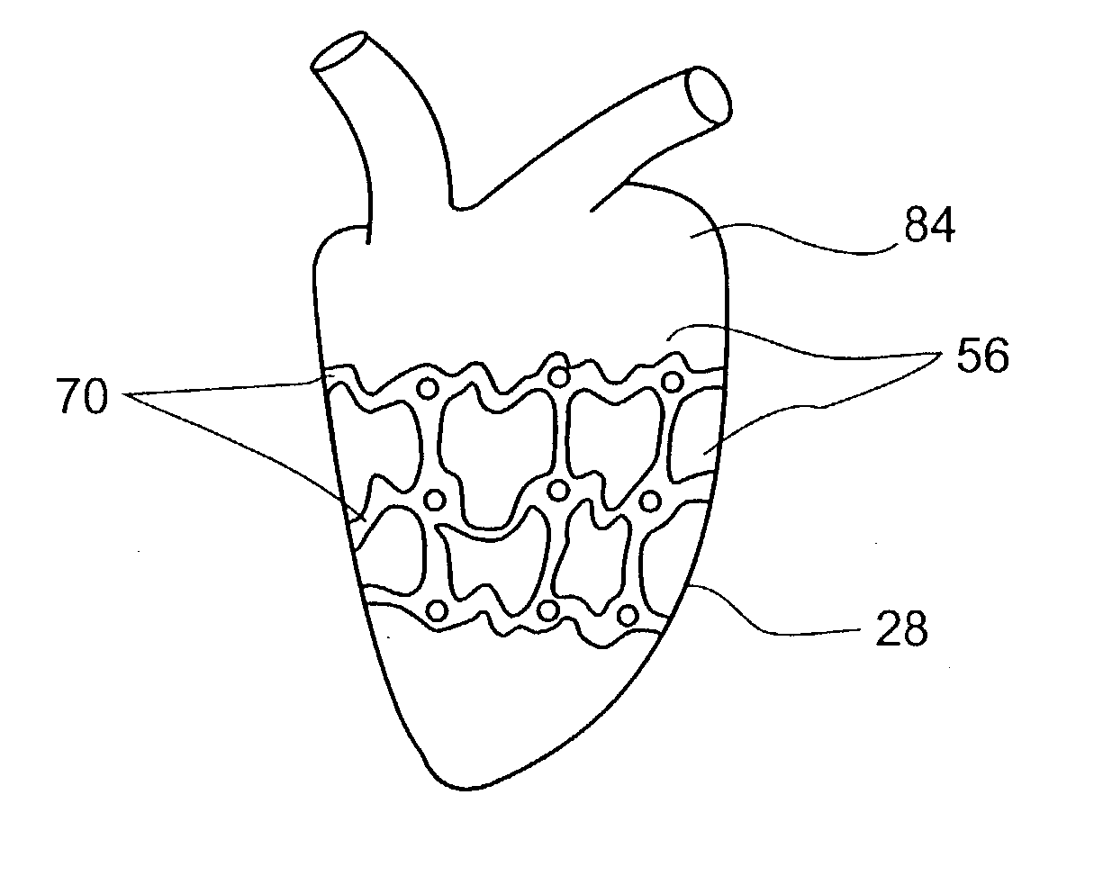 In-vivo method and device for improving diastolic function of the left ventricle