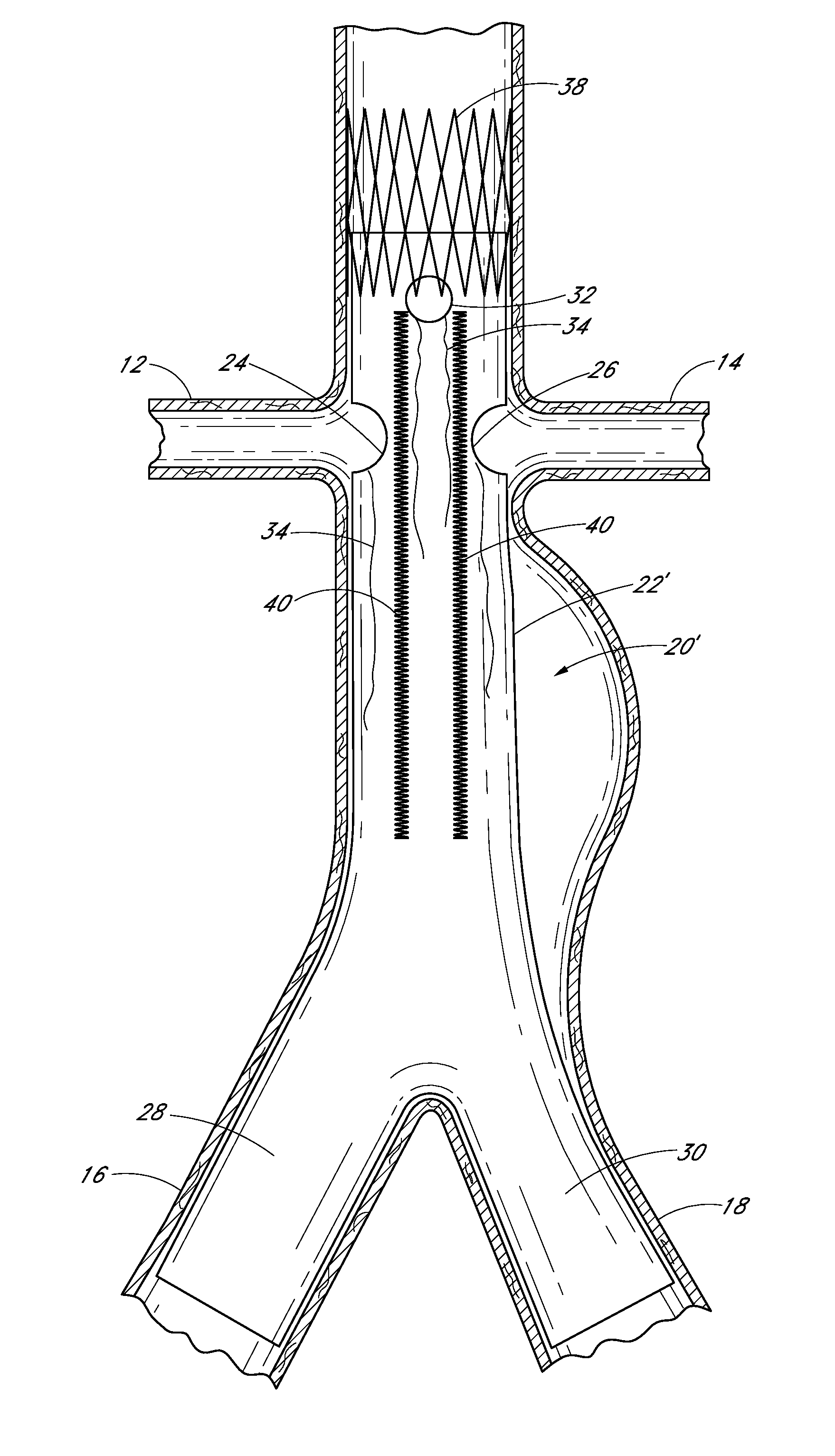 Apparatus and method of placement of a graft or graft system