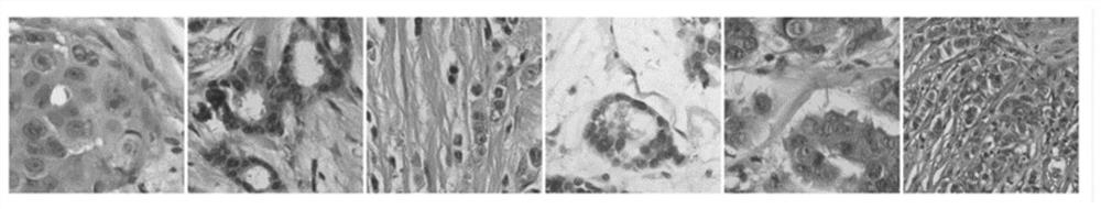 Computer-assisted breast cancer pathological image diagnosis method based on artificial intelligence