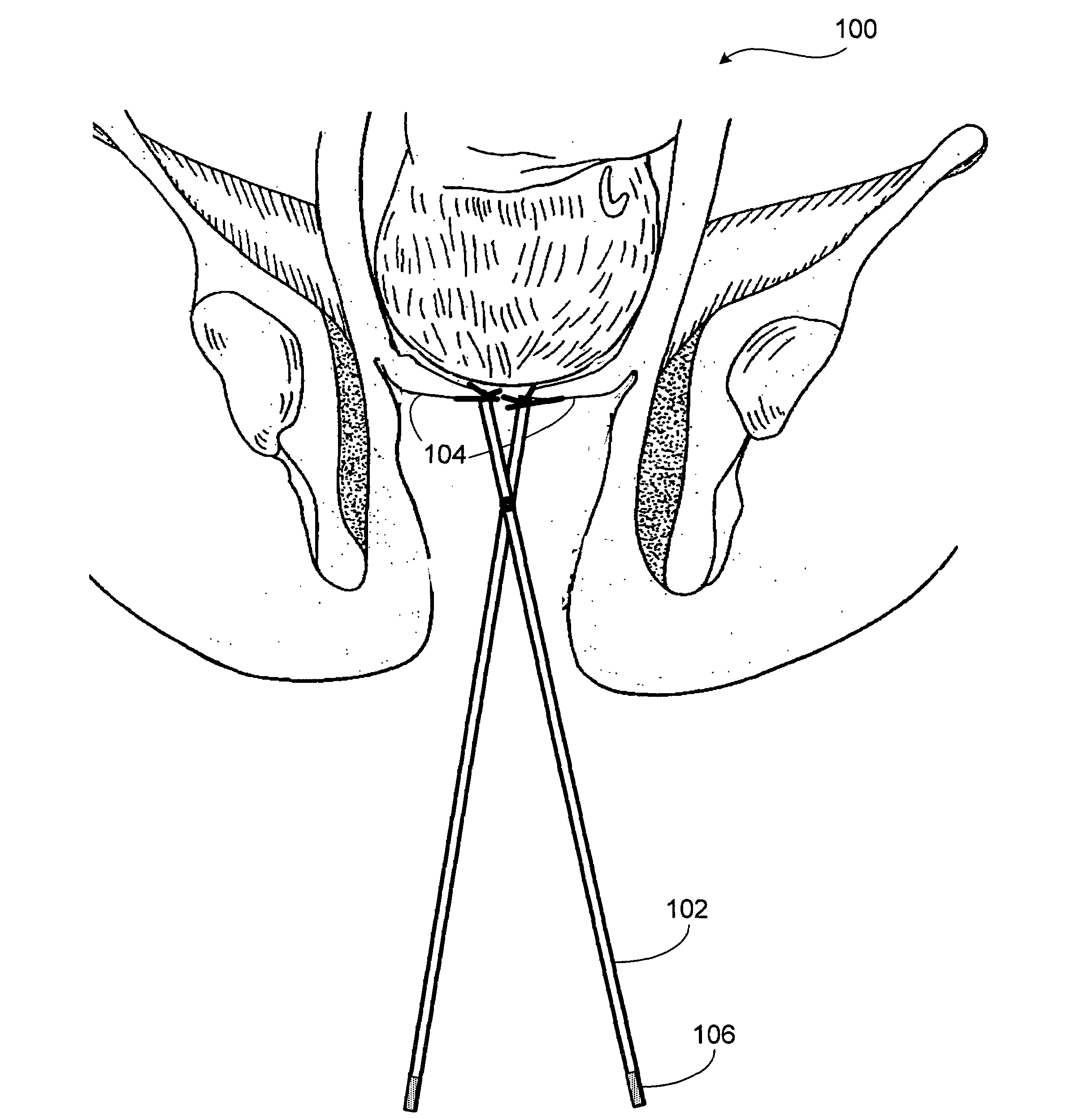 Apparatus and method for detection of cervical dilation during labor