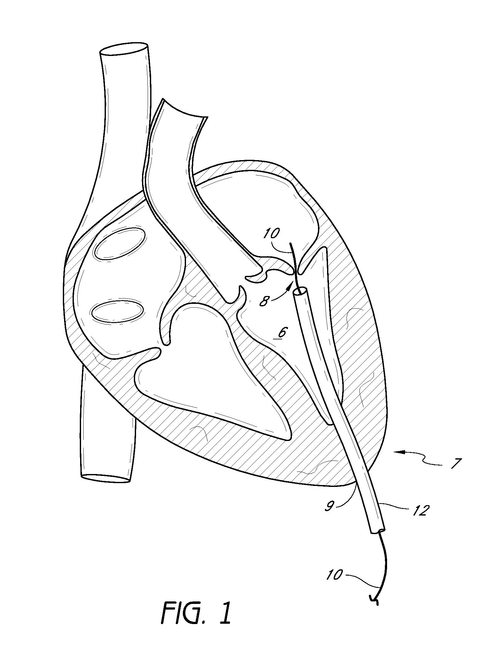 Methods and apparatuses for suturing of cardiac openings