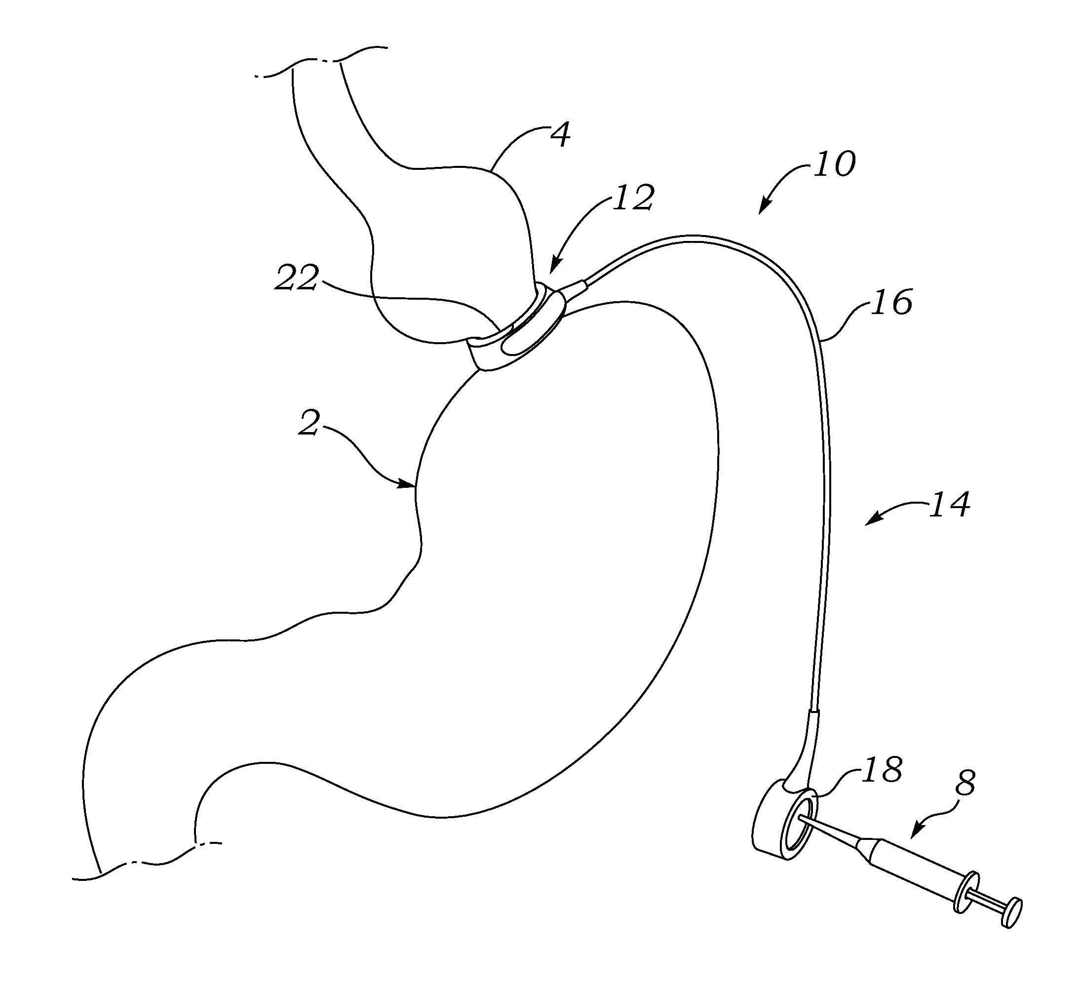 Laparoscopic Gastric Band With Active Agents