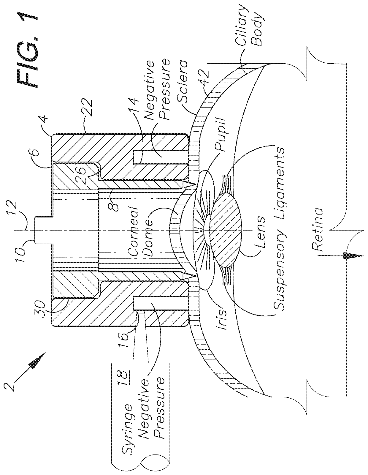 Ophthalmic incisional procedure instrument and method